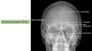 Posteroanterior (PA) 
 