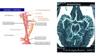 Aneurismas 
