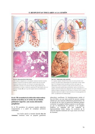 5. RESPUESTAS TISULARES A LA LESIÓN




En la TB secundaria la infección tuberculosa          tuberculoso caseificante. Es histológicamente similar al
inicial se localiza en el vértice de un lóbulo        foco de Ghon, con una zona central de necrosis caseosa
                                                      rodeada por una respuesta inflamatoria granulomatosa. En
pulmonar superior, con escasa afectación              la mayoría de los casos la destrucción pulmonar produce
ganglionar                                            cavitación. Los ganglios linfáticos apenas se ven afectados,
                                                      ya que la diseminación de gérmenes a los ganglios
En la TB secundaria, los gérmenes pueden adquirirse   linfáticos es impedida por una respuesta de
exógenamente o a partir de complejos primarios        hipersensibilidad tisular intensa. La evolución de la
cicatrizados.                                         infección depende totalmente de lo que ocurra con el foco
                                                      de Assmann.
       Una lesión apical (a menudo llamada foco de
Assmann) comienza como un pequeño granuloma




                                                                                                               79
 