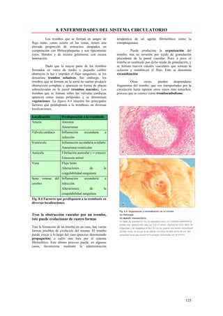 8. ENFERMEDADES DEL SISTEMA CIRCULATORIO
          Los trombos que se forman en sangre de           terapéutica de un agente fibrinolítico como la
flujo lento, corno ocurre en las venas, tienen una         estreptoquinasa.
elevada proporción de eritrocitos atrapados en
comparación con fibrina/plaquetas y son típicamente                 Puede producirse la organización del
rojos, blandos y de textura gelatinosa, con escasa         trombo, tras su invasión por tejido de granulación
laminación.                                                procedente de la pared vascular. Poco a poco el
                                                           trombo es sustituido por dicho tejido de granulación, y
          Dado que la mayor parte de los trombos           se forman nuevos canales vasculares que sortean la
formados en vasos de medio o pequeño calibre               oclusión y restablecen el flujo. Esto se denomina
obstruyen la luz e impiden el flujo sanguíneo, se los      recanalización.
denomina trombos oclusivos. Sin embargo, los
trombos que se forman en la aorta no suelen producir                 Otras     veces,   pueden    desprenderse
obstrucción completa y aparecen en forma de placas         fragmentos del trombo, que son transportados por la
sobreelevadas en la pared (trombos murales). Los           circulación hasta taponar otros vasos más estrechos,
trombos que se forman sobre las válvulas cardiacas         proceso que se conoce como tromboembolismo.
aparecen como masas polipoides y se denominan
vegetaciones. La figura 8.4 muestra los principales
factores que predisponen a la trombosis en diversas
localizaciones.

Localización           Predisposición a la trombosis
Arteria                Ateroma
                       Aneurismas
Válvula cardiaca       Inflamación     secundaria      a
                       infección
Ventrículo             Inflamación secundaria a infarto
                       Aneurisma ventricular
Aurícula               Fibrilación auricular (→ estasis)
                       Estenosis mitral
Vena                   Flujo lento
                       Alteraciones        de         la
                       coagulabilidad sanguínea
Seno venoso        del Inflamación     secundaria      a
cerebro                infección
                       Alteraciones        de         la
                       coagulabilidad sanguínea
Fig. 8.4 Factores que predisponen a la trombosis en
diversas localizaciones.


Tras la obstrucción vascular por un trombo,
éste puede evolucionar de cuatro formas

Tras la formación de un trombo en un vaso, hay varias
formas posibles de evolución del mismo. El trombo
puede crecer a lo largo del vaso (proceso denominado
propagación) o sufrir una lisis por el sistema
fibrinolítico. Este último proceso puede, en algunos
casos, favorecerse mediante la administración




                                                                                                             125
 