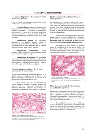 9. APARATO RESPIRATORIO

Los cánceres del pulmón se diseminan a través de                El adenocarcinoma del pulmón suele ser un
cuatro vías principales                                         tumor periférico

Todos los tipos de carcinoma pulmonar diseminan por las         Los adenocarcinomas afectan por igual a ambos sexos y
vías habituales de metastatización.                             no se relacionan tan estrechamente con el tabaco como los
                                                                otros tipos. Son típicamente periféricos, aunque pueden
          Extensión local: un carcinoma surgido en un           aparecer como lesión central que surge de un bronquio
bronquio invade localmente la pared del mismo y el tejido       principal. Se cree que parte de los adenocarcinomas se
pulmonar circundante. Es frecuente la diseminación              originan en zonas de cicatrización pulmonar preexistente
peribronquial, a lo largo de los bronquios hasta zonas          (cánceres cicatriciales).
distantes del pulmón. La extensión directa a pleura y
estructuras mediastínicas adyacentes es típica de los casos               Existen cuatro patrones histológicos principales:
avanzados.                                                      acinar (espacios de aspecto glandular, fig. 9.30), papilar
                                                                (arborescencias tumorales sobre finos septos conjuntivos),
           Diseminación linfática: los carcinomas               carcinoma sólido con producción de moco (lesiones
diseminan a los ganglios linfáticos hiliares y                  poco diferenciadas) y carcinoma bronquioloalveolar.
peribronquiales ipsilaterales y contralaterales. En tal caso,
la compresión de los tejidos adyacentes por los ganglios                  La mayoría de estos tumores no producen
linfáticos infiltrados puede producir síntomas.                 signos de obstrucción de las vías aéreas, debido a su
                                                                localización periférica. No es raro que una metastatización
         Diseminación       transcelómica:       células        sistémica extremadamente extensa proceda de un ade-
tumorales pueden extenderse a la cavidad pleural, donde         nocarcinoma periférico de muy pequeño tamaño.
producen un derrame pleural maligno.

          Diseminación hematógena: los principales
lugares de diseminación hematógena son cerebro, hueso,
hígado y glándulas suprarrenales. Las metástasis óseas son
más frecuentes en costillas, vértebras, húmero y fémur, y
se manifiestan por dolor o fracturas patológicas.


El carcinoma epidermoide es el tipo de cáncer
más frecuente de los bronquios

Se cree que los carcinomas epidermoides aparecen en el
epitelio escamoso metaplásico que se forma en los
bronquios principales a consecuencia de la exposición a
agentes como el humo del tabaco (fig. 9.29).

          Los tumores, que son más frecuentes en
varones, suelen ser centrales y cercanos a la carina; sus
síntomas están con frecuencia relacionados con                  El carcinoma bronquioloalveolar es un tipo
obstrucción bronquial. Comparados con otros tipos, su           especial de adenocarcinoma
crecimiento es relativamente lento y pueden ser resecados.
                                                                El carcinoma bronquioloalveolar del pulmón es un tipo
                                                                especial de adenocarcinoma que representa un 5% de los
                                                                casos y procede de células epiteliales alveolares o
                                                                bronquiales (células de Clara y neumocitos de tipo II). Un
                                                                aspecto histológico típico de estos tumores es su extensión
                                                                a lo largo de los septos alveolares.

                                                                          La mitad de los casos son tumores infiltrantes
                                                                difusos y multifocales, que sustituyen áreas pulmonares de
                                                                forma que recuerda una hepatización neumónica. Las
                                                                células son altas, cilíndricas y relativamente uniformes,
                                                                presentan pocas mitosis y segregan mucina.




                                                                                                                      182
 