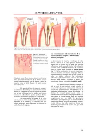 10. PATOLOGÍA ORAL Y ORL




                                                            Las complicaciones más importantes de la
                                                            caries dental son pulpitis e inflamación o
                                                            absceso periapical

                                                            La diseminación de bacterias y ácido por la pulpa
                                                            blanda a través de la caries produce necrosis de
                                                            algunos de los tejidos de la pulpa, con reacción
                                                            inflamatoria aguda asociada (sobre todo dilatación
                                                            vascular, edema e infiltrado neutrófilo). Si la necrosis
                                                            tisular es extensa puede formarse un absceso pulpar
                                                            (fig. 10.15). La combinación de necrosis bacteriana y
                                                            ácida con aumento de la presión intrapulpar debida al
                                                            edema inflamatorio producen una necrosis extensa de
                                                            todos los tejidos pulpa-res. La estimulación
Esto, junto con el efecto desmineralizante continuo del     inflamatoria de las terminaciones nerviosas de la pulpa
ácido, provoca la licuefacción de la dentina. Con el        provoca dolor intenso, localizado o difuso, que
tiempo se perfora toda la capa de dentina y tanto las       constituye el síntoma principal de la pulpitis aguda.
bacterias como el ácido llegan a la pulpa central
blanda del diente.                                                     Si la penetración del esmalte y la dentina ha
                                                            sido a través de un conducto cariado estrecho, la
           A lo largo de la línea de ataque, el esmalte y   cavidad pulpar permanece prácticamente aislada de la
la dentina son destruidos y los odontoblastos mueren.       cavidad oral (pulpitis cerrada). Sin embargo, si se ha
Aunque la capacidad de reacción tisular es limitada         producido una destrucción extensa del esmalte y la
por la baja celularidad de los tejidos, en lesiones         dentina, la cavidad pulpar puede entrar en
crónicas los odontoblastos pueden producir dentina          comunicación con la cavidad oral (pulpitis abierta). En
secundaria en un intento de reparación y restitución.       tales casos, la cavidad pulpar suele ser sustituida
           Las consecuencias del ataque de la caries        completamente por un tejido de granulación
son un pozo o cráter en el esmalte, una destrucción         inflamatoria, que va pasando por las fases de tejido de
penetrante en la dentina y, si atraviesa ésta, una          granulación vascular, tejido de granulación fibroso y
pulpitis aguda por lesión bacteriana y ácida de los         cicatriz fibrosa. La pulpa cicatricial forma una
tejidos blandos de la pulpa.                                protrusión polipoide hacia la cavidad oral, que puede
                                                            epitelizarse de nuevo.




                                                                                                               200
 
