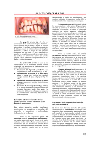 10. PATOLOGÍA ORAL Y ORL
                                                           paraqueratósica, y pueden ser multiloculares y en
                                                           ocasiones múltiples. Su tratamiento resulta difícil y
                                                           tienden a recidivar tras una extirpación incompleta.

                                                                     Los quistes dentígeros afectan sobre todo a
                                                           los terceros molares o a los caninos. El quiste típico
                                                           envuelve la corona de un diente no erupcionado o
                                                           desplazado y se adhiere a su cuello. El quiste está
                                                           recubierto de epitelio escamoso estratificado,
                                                           generalmente con pocas capas de grosor, sostenido por
                                                           un tabique fibroso fuerte. En su unión con el cuello del
                                                           diente, el epitelio del quiste se continúa con los
                                                           escasos restos del epitelio del esmalte. Contiene un
                                                           líquido amarillento, generalmente transparente. No
           La gingivitis crónica (fig. 10. 16a) es         obstante, la metaplasia del epitelio escamoso que
consecuencia de la acumulación de placa bacteriana.        reviste el quiste puede hacer que se produzcan
Suele comenzar en la infancia, durante la cual es          queratina y mucina, lo que proporciona al contenido
asintomática. El cepillado regular de los dientes desde    del quiste un carácter mucoso o pastoso. Estos quistes
la infancia, reduce al mínimo el depósito de placa         derivan del folículo dental del diente no erupcionado y
bacteriana y reduce el riesgo de una gingivitis            son uniloculares.
importante aún más tarde. La placa bacteriana se
calcifica en los adultos, separando la encía del diente.              Como su nombre indica, los quistes
Se produce una inflamación crónica del epitelio            periodontales laterales se sitúan a un lado del diente.
gingival y de la submucosa, con gran número de lin-        Generalmente son asintomáticos y se detectan en
focitos y células plasmáticas.                             radiografías dentales casuales en forma de lesión
                                                           osteolítica redondeada separada y por fuera de la raíz
           La periodontitis crónica se debe a las          de un canino o un premolar. El quiste está revestido
consecuencias de la inflamación gingival crónica           por un epitelio escamoso no queratinizado, rodeado
relacionada con la presencia de placa calculosa entre      por un tabique fibroso.
encía y diente. Estas son:
•    Destrucción del ligamento periodontal, con                       El quiste inflamatorio más importante es el
     aflojamiento del diente en su alvéolo (fig.10.16b).   quiste radicular. Es mucho más frecuente que los
•    Profundización progresiva de la bolsa entre           quistes del desarrollo y generalmente se producen en
     diente y encía, que contiene una cantidad             adultos asociado a caries dental de la dentadura
     siempre creciente de placa subgingival (fig. 10.      permanente. Generalmente afecta a los incisivos
     16b).                                                 laterales superiores, tras la formación de un granuloma
•    Destrucción inflamatoria progresiva del hueso         periapical a consecuencia de la caries. En la masa
     alveolar, que provoca recesión gingival intensa       inflamatoria crónica crecen cordones de epitelio
     (fig. 10.17).                                         escamoso y la disolución central de las masas
                                                           epiteliales provoca la formación del quiste. El tabique
•    Formación de absceso periodontal (fig. 10.16c)
                                                           está normalmente inflamado y son frecuentes las
     si al proceso inflamatorio crónico se añade una
                                                           hendiduras de colesterol, a menudo asociadas a células
     infección bacteriana aguda. Esto acelera la
                                                           gigantes de cuerpo extraño. El diente afectado muere y
     destrucción del hueso alveolar y puede salir pus a
                                                           el quiste puede persistir tras la extracción de la pieza.
     la cavidad alveolar o a lo largo del diente en la
                                                           Al crecer el quiste inflamatorio crónico, puede
     bolsa subgingival.
                                                           erosionar el hueso circundante y producir una zona
                                                           bien delimitada de radiotransparencia.
Los quistes relacionados con los dientes
pueden producir lesiones osteolíticas en los               Los tumores derivados de tejidos dentarios
huesos de la mandíbula                                     precursores son raros
Los quistes dentarios pueden clasificarse                  El tumor más frecuente derivado del epitelio
simplemente en secundarios a anomalías del                 odontogénico es el ameloblastoma. Es benigno y no
desarrollo y secundarios a enfermedades                    metastatiza. Estos tumores suelen aparecer sobre todo
inflamatorias de los dientes.                              en la mandíbula en adultos de edad media, la inmensa
                                                           mayoría en el ángulo de la mandíbula. Son lesiones de
          Entre los más importantes quistes del            crecimiento lento, que invaden localmente el hueso.
desarrollo están los queratoquistes odontogénicos,         La expansión tumoral suele separar los dientes y a
que suelen aparecer en varones jóvenes en la región        veces los afloja. Están formados por islas de epitelio
molar del maxilar inferior. Pueden ser asintomáticos o     odontogénico, a menudo con un estroma fibroso
manifestarse por una tumefacción intraoral. Están          mixto. El epitelio odontogénico forma islotes con
revestidos por epitelio escamoso estratificado, con una    células epiteliales ameloblásticas periféricas altas
capa de queratina variable que es a veces



                                                                                                               202
 