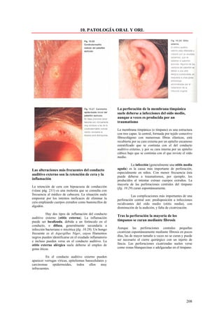 10. PATOLOGÍA ORAL Y ORL




                                                         La perforación de la membrana timpánica
                                                         suele deberse a infecciones del oído medio,
                                                         aunque a veces es producida por un
                                                         traumatismo

                                                         La membrana timpánica (o tímpano) es una estructura
                                                         con tres capas: la central, formada por tejido conectivo
                                                         fibrocolágeno con numerosas fibras elásticas, está
                                                         recubierta por su cara externa por un epitelio escamoso
                                                         estratificado que se continúa con el del conducto
                                                         auditivo externo, y por su cara interna por un epitelio
                                                         cúbico bajo que se continúa con el que reviste el oído
                                                         medio.

                                                                    La infección (generalmente una otitis media
Las alteraciones más frecuentes del conducto             aguda) es la causa más importante de perforación,
                                                         especialmente en niños. Con menor frecuencia ésta
auditivo externo son la retención de cera y la
                                                         puede deberse a traumatismos, por ejemplo, los
inflamación                                              producidos al intentar extraer cuerpos extraños. La
                                                         mayoría de las perforaciones centrales del tímpano
La retención de cera con hipoacusia de conducción        (fig. 10.29) curan espontáneamente.
(véase pág. 211) es una molestia que se consulta con
frecuencia al médico de cabecera. La situación suele               Las complicaciones más importantes de una
empeorar por los intentos ineficaces de eliminar la      perforación central son: predisposición a infecciones
cera empleando cuerpos extraños como bastoncillos de     recidivantes del oído medio (otitis media), con
algodón.                                                 disminución de la audición, y falta de cicatrización.
          Hay dos tipos de inflamación del conducto
                                                         Tras la perforación la mayoría de los
auditivo externo (otitis externa). La inflamación
puede ser localizada, debida a un forúnculo en el        tímpanos se curan mediante fibrosis
conducto, o difusa, generalmente secundaria a
infección bacteriana o micótica (fig. 10.28). Un hongo   Aunque las perforaciones centrales pequeñas
frecuente es el Aspergillus Níger, cuyos filamentos      cicatrizan espontáneamente mediante fibrosis en pocos
negros pueden identificarse en el exudado inflamatorio   días, las de mayor tamaño a veces no se curan y puede
e incluso pueden verse en el conducto auditivo. La       ser necesario el cierre quirúrgico con un injerto de
otitis externa alérgica suele deberse al empleo de       fascia. Las perforaciones cicatrizadas suelen verse
gotas óticas.                                            como zonas blanquecinas o adelgazadas en el tímpano.

          En el conducto auditivo externo pueden
aparecer verrugas víricas, epiteliomas basocelulares y
carcinomas    epidermoides,       todos  ellos muy
infrecuentes.




                                                                                                            208
 