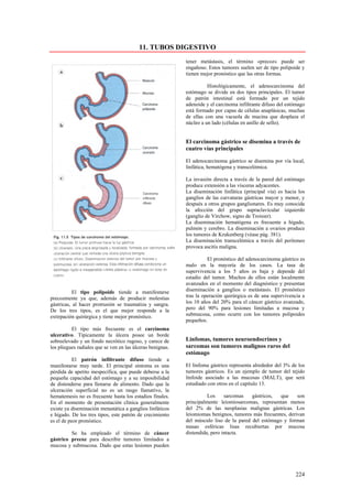 11. TUBOS DIGESTIVO
                                                            tener metástasis, el término «precoz» puede ser
                                                            engañoso. Estos tumores suelen ser de tipo polipoide y
                                                            tienen mejor pronóstico que las otras formas.

                                                                      Histológicamente, el adenocarcinoma del
                                                            estómago se divide en dos tipos principales. El tumor
                                                            de patrón intestinal está formado por un tejido
                                                            adenoide y el carcinoma infiltrante difuso del estómago
                                                            está formado por capas de células anaplásicas, muchas
                                                            de ellas con una vacuola de mucina que desplaza el
                                                            núcleo a un lado (células en anillo de sello).


                                                            El carcinoma gástrico se disemina a través de
                                                            cuatro vías principales

                                                            El adenocarcinoma gástrico se disemina por vía local,
                                                            linfática, hematógena y transcelómica.

                                                            La invasión directa a través de la pared del estómago
                                                            produce extensión a las vísceras adyacentes.
                                                            La diseminación linfática (principal vía) es hacia los
                                                            ganglios de las curvaturas gástricas mayor y menor, y
                                                            después a otros grupos ganglionares. Es muy conocida
                                                            la afección del grupo supraclavicular izquierdo
                                                            (ganglio de Virchow, signo de Troisier).
                                                            La diseminación hematógena es frecuente a hígado,
                                                            pulmón y cerebro. La diseminación a ovarios produce
                                                            los tumores de Krukenberg (véase pág. 381).
                                                            La diseminación transcelómica a través del peritoneo
                                                            provoca ascitis maligna.

                                                                      El pronóstico del adenocarcinoma gástrico es
                                                            malo en la mayoría de los casos. La tasa de
                                                            supervivencia a los 5 años es baja y depende del
                                                            estadio del tumor. Muchos de ellos están localmente
                                                            avanzados en el momento del diagnóstico y presentan
           El tipo polipoide tiende a manifestarse          diseminación a ganglios o metástasis. El pronóstico
precozmente ya que, además de producir molestias            tras la operación quirúrgica es de una supervivencia a
gástricas, al hacer protrusión se traumatiza y sangra.      los 10 años del 20% para el cáncer gástrico avanzado,
De los tres tipos, es el que mejor responde a la            pero del 90% para lesiones limitadas a mucosa y
extirpación quirúrgica y tiene mejor pronóstico.            submucosa, como ocurre con los tumores polipoides
                                                            pequeños.
          El tipo más frecuente es el carcinoma
ulcerativo. Típicamente la úlcera posee un borde
sobreelevado y un fondo necrótico rugoso, y carece de       Linfomas, tumores neuroendocrinos y
los pliegues radiales que se ven en las úlceras benignas.   sarcomas son tumores malignos raros del
                                                            estómago
           El patrón infiltrante difuso tiende a
manifestarse muy tarde. El principal síntoma es una         El linfoma gástrico representa alrededor del 3% de los
pérdida de apetito inespecífica, que puede deberse a la     tumores gástricos. Es un ejemplo de tumor del tejido
pequeña capacidad del estómago y a su imposibilidad         linfoide asociado a las mucosas (MALT), que será
de distenderse para llenarse de alimento. Dado que la       estudiado con otros en el capítulo 13.
ulceración superficial no es un rasgo llamativo, la
hematemesis no es frecuente hasta los estadios finales.               Los     sarcomas   gástricos,  que     son
En el momento de presentación clínica generalmente          principalmente leiomiosarcomas, representan menos
existe ya diseminación metastática a ganglios linfáticos    del 2% de las neoplasias malignas gástricas. Los
e hígado. De los tres tipos, este patrón de crecimiento     leiomiomas benignos, tumores más frecuentes, derivan
es el de peor pronóstico.                                   del músculo liso de la pared del estómago y forman
                                                            masas esféricas lisas recubiertas por mucosa
         Se ha empleado el término de cáncer                distendida, pero intacta.
gástrico precoz para describir tumores limitados a
mucosa y submucosa. Dado que estas lesiones pueden




                                                                                                              224
 