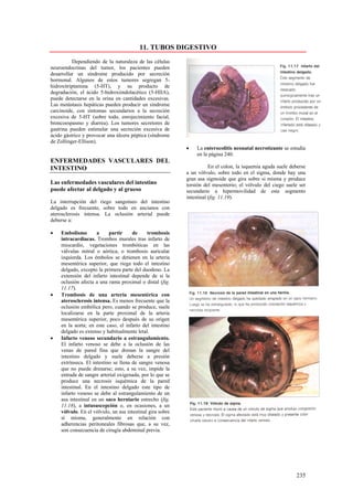 11. TUBOS DIGESTIVO
          Dependiendo de la naturaleza de las células
neuroendocrinas del tumor, los pacientes pueden
desarrollar un síndrome producido por secreción
hormonal. Algunos de estos tumores segregan 5-
hidroxitriptamina (5-HT), y su producto de
degradación, el ácido 5-hidroxiindolacético (5-HIIA),
puede detectarse en la orina en cantidades excesivas.
Las metástasis hepáticas pueden producir un síndrome
carcinoide, con síntomas secundarios a la secreción
excesiva de 5-HT (sobre todo, enrojecimiento facial,
broncoespasmo y diarrea). Los tumores secretores de
gastrina pueden estimular una secreción excesiva de
ácido gástrico y provocar una úlcera péptica (síndrome
de Zollinger-Ellison).
                                                           •   La enterocolitis neonatal necrotizante se estudia
                                                               en la página 240.
ENFERMEDADES VASCULARES DEL
INTESTINO                                                             En el colon, la isquemia aguda suele deberse
                                                           a un vólvulo, sobre todo en el sigma, donde hay una
                                                           gran asa sigmoide que gira sobre si misma y produce
Las enfermedades vasculares del intestino                  torsión del mesenterio; el vólvulo del ciego suele ser
puede afectar al delgado y al grueso                       secundario a hipermovilidad de este segmento
                                                           intestinal (fig. 11.19).
La interrupción del riego sanguíneo del intestino
delgado es frecuente, sobre todo en ancianos con
aterosclerosis intensa. La oclusión arterial puede
deberse a:

•   Embolismo        a     partir     de     trombosis
    intracardiacas. Trombos murales tras infarto de
    miocardio, vegetaciones trombóticas en las
    válvulas mitral o aórtica, o trombosis auricular
    izquierda. Los émbolos se detienen en la arteria
    mesentérica superior, que riega todo el intestino
    delgado, excepto la primera parte del duodeno. La
    extensión del infarto intestinal depende de si la
    oclusión afecta a una rama proximal o distal (fig.
    11.17).
•   Trombosis de una arteria mesentérica con
    aterosclerosis intensa. Es menos frecuente que la
    oclusión embólica pero, cuando se produce, suele
    localizarse en la parte proximal de la arteria
    mesentérica superior, poco después de su origen
    en la aorta; en este caso, el infarto del intestino
    delgado es extenso y habitualmente letal.
•   Infarto venoso secundario a estrangulamiento.
    El infarto venoso se debe a la oclusión de las
    venas de pared fina que drenan la sangre del
    intestino delgado y suele deberse a presión
    extrínseca. El intestino se llena de sangre venosa
    que no puede drenarse; esto, a su vez, impide la
    entrada de sangre arterial oxigenada, por lo que se
    produce una necrosis isquémica de la pared
    intestinal. En el intestino delgado este tipo de
    infarto venoso se debe al estrangulamiento de un
    asa intestinal en un saco herniario estrecho (fig.
    11.18), a intususcepción o, en ocasiones, a un
    vólvulo. En el vólvulo, un asa intestinal gira sobre
    sí misma, generalmente en relación con
    adherencias peritoneales fibrosas que, a su vez,
    son consecuencia de cirugía abdominal previa.




                                                                                                             235
 