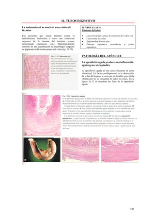 11. TUBOS DIGESTIVO

La melanosis coli se asocia al uso crónico de             PUNTOS CLAVE:
laxantes                                                  Estenosis del colon

Los pacientes que toman laxantes contra el                •    Las principales causas de estenosis del colon son:
estreñimiento desarrollan a veces una coloración          •    Carcinoma de colon.
negruzca de la mucosa del intestino grueso,               •    Enfermedad diverticular.
denominada «melanosis coli». Histológicamente             •    Fibrosis isquémica secundaria a colitis
consiste en una acumulación de macrófagos cargados             isquémica.
de pigmento en la lámina propia del colon (fig. 11.21).

                                                          PATOLOGÍA DEL APÉNDICE

                                                          La apendicitis aguda produce una inflamación
                                                          aguda grave del apéndice

                                                          La apendicitis aguda es una causa frecuente de dolor
                                                          abdominal. Un factor predisponente es la obstrucción
                                                          de la luz del órgano, a veces por un fecalito, pero dicha
                                                          obstrucción no se encuentra en todos los casos. En la
                                                          figura 11.22 se muestran las fases de la apendicitis
                                                          aguda.




                                                                                                              237
 