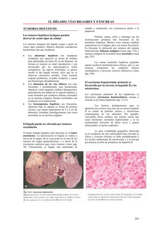12. HÍGADO, VÍAS BILIARES Y PÁNCREAS

TUMORES HEPÁTICOS                                         tamaño y endurecido, con consistencia pétrea a la
                                                          palpación.
Los tumores hepáticos benignos pueden
                                                                     Pulmón, mama, colon y estómago son las
derivar de varios tipos de células                        localizaciones primarias más frecuentes de las
                                                          metástasis hepáticas. Muchos otros tumores también
Los tumores benignos del hígado surgen a partir de        metastatizan en el hígado, pero con menor frecuencia.
varios tipos celulares. Muchos deberían considerarse      Es frecuente la afectación por tumores del sistema
hamartomas más que neoplasias.                            linforreticular, linfomas malignos (véase pág. 274) y
                                                          tumores malignos de la médula ósea, leucemias (véase
•   Los adenomas hepáticos son neoplasias                 pág. 292).
    verdaderas que aparecen en forma de nódulos
    bien delimitados de hasta 20 cm de diámetro. Se                 Las masas tumorales hepáticas pequeñas
    forman en mujeres en edad reproductora y son          apenas producen manifestaciones clínicas, pero si son
    favorecidos por los anticonceptivos orales            extensas comprimen los conductos biliares
    estrogénicos. Su aspecto histológico se parece        intrahepáticos y provocan ictericia obstructiva (véase
    mucho al del hígado normal, salvo que no se           pág. 244).
    observan estructuras portales. Estas lesiones
    originan problemas, al poder romperse y causar
    una hemorragia intraabdominal.
                                                          El carcinoma hepatocelular primario es
•   Los adenomas de las vías biliares son muy
                                                          favorecido por la cirrosis, la hepatitis B y las
    frecuentes y probablemente sean hamartomas.
    Aparecen como pequeños nódulos blanquecinos,          micotoxinas
    generalmente por debajo de la cápsula hepática, y
    están formados por conductos biliares anormales       Los carcinomas primarios de los hepatocitos se
    en un estroma colágeno. Pueden confundirse con        denominan carcinomas hepatocelulares, aunque a
    metástasis en la laparotomía.                         menudo se les llama hepatomas (fig. 12.31).
•   Los hemangiomas hepáticos son frecuentes.
                                                                    Los factores predisponentes para su
    Aparecen bajo la cápsula en forma de lesiones
                                                          aparición son cirrosis (sea cual sea su causa), hepatitis
    oscuras, casi negras (típicamente de 2 a 3 cm de
                                                          B en estado de portador crónico y micotoxinas
    diámetro), formadas, histológicamente, por vasos
                                                          contaminantes de los alimentos. Por ejemplo,
    anormales en un estroma colágeno.
                                                          Aspergillus flavus produce una potente toxina que
                                                          causa fácilmente carcinoma hepatocelular y es un
                                                          contaminante frecuente de frutos secos y granos
El hígado puede ser afectado por tumores                  almacenados, en países tropicales.
secundarios
                                                                    La gran variabilidad geográfica observada
El tumor maligno hepático más frecuente es el tumor       en la incidencia de esta enfermedad (muy elevada en
metastásico. La diseminación al hígado se realiza a       África y Extremo Oriente) se debe probablemente a
través de la sangre, de la vena porta en el caso de los   los niveles ambientales de micotoxinas y a la elevada
tumores de origen gastrointestinal, o a través de la      prevalencia en ellos de portadores de hepatitis B.
circulación sistémica para otros tumores (véase pág.
39). Clínicamente, el hígado está aumentado de




                                                                                                              263
 