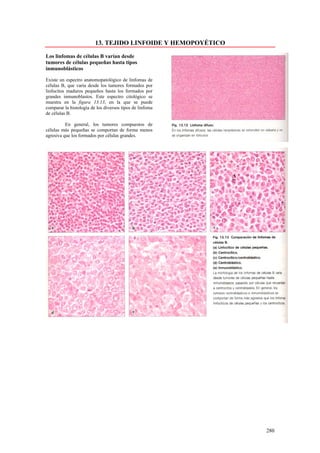 13. TEJIDO LINFOIDE Y HEMOPOYÉTICO

Los linfomas de células B varían desde
tumores de células pequeñas hasta tipos
inmunoblásticos

Existe un espectro anatomopatológico de linfomas de
células B, que varía desde los tumores formados por
linfocitos maduros pequeños hasta los formados por
grandes inmunoblastos. Este espectro citológico se
muestra en la figura 13.13, en la que se puede
comparar la histología de los diversos tipos de linfoma
de células B.

          En general, los tumores compuestos de
células más pequeñas se comportan de forma menos
agresiva que los formados por células grandes.




                                                              280
 