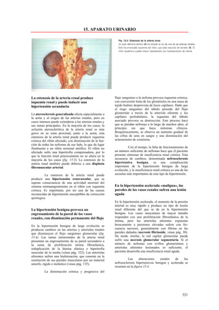 15. APARATO URINARIO




La estenosis de la arteria renal produce                   flujo sanguíneo a la nefrona provoca isquemia crónica,
isquemia renal y puede inducir una                         con conversión lenta de los glomérulos en una masa de
hipertensión secundaria                                    tejido hialino desprovista de luces capilares. Dado que
                                                           el riego sanguíneo del túbulo procede del flujo
La aterosclerosis generalizada afecta especialmente a      glomerular a través de la arteriola eferente y los
la aorta y al origen de las arterias renales, pero en      capilares peritubulares, la isquemia del túbulo
casos intensos puede extenderse a las arterias renales y   asociado provoca su destrucción. Este proceso hace
sus ramas principales. En la mayoría de los casos, la      que se pierdan nefronas a lo largo de muchos años, al
oclusión aterosclerótica de la arteria renal es más        principio sin que haya síntomas clínicos.
grave en su zona proximal, junto a la aorta; esta          Bioquímicamente, se observa un aumento gradual de
estenosis de la arteria renal puede producir isquemia      las cifras de urea en sangre y una disminución del
crónica del riñón afectado, con disminución de la fun-     aclaramiento de creatinina.
ción de todas las nefronas de ese lado, lo que da lugar
finalmente a un riñón terminal atrófico. El riñón no                 Con el tiempo, la falta de funcionamiento de
afectado sufre una hipertrofia compensadora, por lo        un número suficiente de nefronas hace que el paciente
que la función renal prácticamente no se altera en la      presente síntomas de insuficiencia renal crónica. Esta
mayoría de los casos (fig. 15.3). La estenosis de la       secuencia de cambios, denominada nefroesclerosis
arteria renal también puede deberse a una displasia        hipertensiva benigna, es una complicación
fibromuscular arterial.                                    importante de la hipertensión benigna de larga
                                                           evolución, y la insuficiencia renal crónica es una de las
          La estenosis de la arteria renal puede           secuelas más importantes de este tipo de hipertensión.
producir una hipertensión renovascular, que se
supone consecuencia de una actividad anormal del
sistema reninaangiotensina en el riñón con isquemia        En la hipertensión acelerada «maligna», las
crónica. Es importante, por ser una de las causas          paredes de los vasos renales sufren una lesión
reconocidas de hipertensión susceptibles de corrección     aguda
quirúrgica.
                                                           En la hipertensión acelerada, el aumento de la presión
                                                           arterial es muy rápido y produce un tipo de lesión
La hipertensión benigna provoca un                         renal diferente del que se da en la hipertensión
engrosamiento de la pared de los vasos                     benigna. Los vasos musculares de mayor tamaño
renales, con disminución permanente del flujo              responden con una proliferación fibroelástica de la
                                                           íntima, pero las arteriolas aferentes expuestas
En la hipertensión benigna de larga evolución se           bruscamente a presiones elevadas sufren con fre-
producen cambios en las arterias y arteriolas renales      cuencia necrosis, generalmente con fibrina en las
que disminuyen el flujo sanguíneo glomerular (fig.         paredes dañadas (necrosis fibrinoide, véase pág. 30).
15.4). Las ramas intrarrenales de la arteria renal         De modo similar, la red capilar glomerular puede
presentan un engrosamiento de su pared secundario a        sufrir una necrosis glomerular segmentaria. Si el
la suma de proliferación íntima fibroelástica,             número de nefronas con ovillos glomerulares y
reduplicación de la lámina elástica e hipertrofia          arteriolas aferentes lesionados es suficiente, el
muscular de la media (véase pág. 322). Las arteriolas      paciente desarrolla una insuficiencia renal aguda.
aferentes sufren una hialinización, que consiste en la
sustitución de sus paredes musculares por un material                Las     alteraciones   renales   de    las
amorfo, rígido e inelástico (véase pág. 135).              nefroesclerosis hipertensivas benigna y acelerada se
                                                           resumen en la figura 15.4.
          La disminución crónica y progresiva del




                                                                                                               321
 
