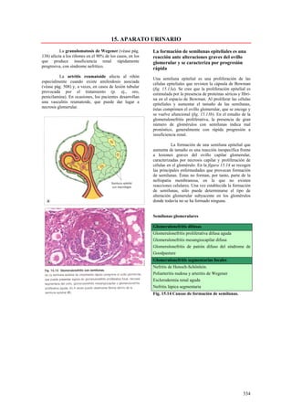 15. APARATO URINARIO
          La granulomatosís de Wegener (véase pág.         La formación de semilunas epiteliales es una
138) afecta a los riñones en el 90% de los casos, en los   reacción ante alteraciones graves del ovillo
que produce insuficiencia renal rápidamente                glomerular y se caracteriza por progresión
progresiva, con síndrome nefrítico.
                                                           rápida
          La artritis reumatoide afecta al riñón
                                                           Una semiluna epitelial es una proliferación de las
especialmente cuando existe amiloidosis asociada
                                                           células epiteliales que revisten la cápsula de Bowman
(véase pág. 508) y, a veces, en casos de lesión tubular
                                                           (fig. 15.13a). Se cree que la proliferación epitelial es
provocada por el tratamiento (p. ej., oro,
                                                           estimulada por la presencia de proteínas séricas y fibri-
penicilamina). En ocasiones, los pacientes desarrollan
                                                           na en el espacio de Bowman. Al proliferar las células
una vasculitis reumatoide, que puede dar lugar a
                                                           epiteliales y aumentar el tamaño de las semilunas,
necrosis glomerular.
                                                           éstas comprimen el ovillo glomerular, que se encoge y
                                                           se vuelve afuncional (fig. 15.13b). En el estudio de la
                                                           glomerulonefritis proliferativa, la presencia de gran
                                                           número de glomérulos con semilunas indica mal
                                                           pronóstico, generalmente con rápida progresión a
                                                           insuficiencia renal.

                                                                     La formación de una semiluna epitelial que
                                                           aumenta de tamaño es una reacción inespecífica frente
                                                           a lesiones graves del ovillo capilar glomerular,
                                                           caracterizadas por necrosis capilar y proliferación de
                                                           células en el glomérulo. En la figura 15.14 se recogen
                                                           las principales enfermedades que provocan formación
                                                           de semilunas. Éstas no forman, por tanto, parte de la
                                                           nefropatia membranosa, en la que no existen
                                                           reacciones celulares. Una vez establecida la formación
                                                           de semilunas, sólo puede determinarse el tipo de
                                                           alteración glomerular subyacente en los glomérulos
                                                           donde todavía no se ha formado ninguna.


                                                           Semilunas glomerulares

                                                           Glomerulonefritis difusas
                                                           Glomerulonefritis proliferativa difusa aguda
                                                           Glomerulonefritis mesangiocapilar difusa
                                                           Glomerulonefritis de patrón difuso del síndrome de
                                                           Goodpasture
                                                           Glomerulonefritis segmentarias focales
                                                           Nefritis de Henoch-Schönlein.
                                                           Poliarteritis nudosa y arteritis de Wegener
                                                           Esclerodermia renal aguda
                                                           Nefritis lúpica segmentaria
                                                           Fig. 15.14 Causas de formación de semilunas.




                                                                                                               334
 