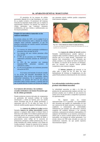 16. APARATO GENITAL MASCULINO
           El pronóstico de los tumores de células          que presentan mitosis también pueden comportarse
germinales depende de su tipo histológico, así como         como tumores malignos.
de su estadio evolutivo. El pronóstico del teratoma
testicular ha mejorado mucho desde que se emplea la
quimioterapia citotóxica. En general, los tumores de
células germinales que contienen elementos
trofoblásticos, del saco vitelino o indiferenciados son
los de peor pronóstico.

Empleo de marcadores tumorales en los
tumores testiculares

Los niveles séricos de AFP y de la unidad ß de la
GCH deben determinarse antes y después de extirpar
cualquier tumor testicular sospechoso, ya que son
proteínas producidas por muchos tumores testiculares
de células germinales.

•    Los tumores de células germinales trofoblásticos
     presentan cifras elevadas de GCH.
                                                                      Los tumores de células de Sertoli (también
•    Los tumores del saco vitelino presentan cifras         llamados «androblastomas») pueden aparecer a
     altas de AFP.                                          cualquier edad, incluida la infancia, pero su incidencia
•    El 90% de los pacientes con TMND/carcinoma             máxima está en la cuarta década. Típicamente son
     embrionario presentan aumento de AFP/GCH o             tumores bien circunscritos y están formados por
     ambos.                                                 células similares a las células de Sertoli normales de
•    El 50% de los pacientes con teratoma                   los túbulos. La mayoría de las lesiones son benignas,
     (inmaduro/TMI)       presentan    aumento     de       pero los tumores con muchas mitosis pueden
     AFP/GCH o ambos.                                       comportarse como tumores malignos.
•    El 10% de los pacientes con seminoma presentan
     elevación de GCH.                                               El linfoma primario del testículo se da
                                                            sobre todo a partir de los 50 años. Se trata
          Sí el tumor está limitado al testículo (estadio   habitualmente de linfomas no hodgkinianos de alto
1), los niveles del marcador descenderán tras la            grado.Puede producirse diseminación de otros tumores.
orquidectomía. Silos niveles no descienden, indican
enfermedad metastásica. En el seguimiento tras el
tratamiento, un aumento del nivel de una proteína
marcadora indica recidiva tumoral, a menudo antes de
que se pueda detectar el tumor con técnicas de imagen.      Las enfermedades testiculares pueden
                                                            producir infertilidad masculina

Los tumores del estroma y los cordones                      La infertilidad masculina se debe a la falta de
sexuales testiculares son menos frecuentes que              producción de espermatozoides maduros móviles. Las
los de células germinales                                   primeras pruebas son el análisis de una muestra de
                                                            semen con el fin de proceder a comprobar la presencia
Pueden producirse tumores derivados de componentes          de espermatozoides.
no germinales del testículo (células de Leydig
intersticiales y células de Sertoli), pero son mucho                   En     algunos      casos      no      existen
menos frecuentes que los de células germinales, y           espermatozoides en el eyaculado. Las enfermedades
representan sólo un 5% de todos los casos. En el            más frecuentes que pueden ser responsables de esto
testículo también pueden aparecer linfomas primarios.       son: destrucción de tejido testicular o cicatrices en los
                                                            conductos a consecuencia de enfermedades
           Los tumores de células de Leydig (también        inflamatorias, por ejemplo, tras infecciones; ausencia
llamados tumores de células intersticiales) pueden          congénita del conducto deferente o las vesículas
aparecer a cualquier edad, desde la infancia hasta el       seminales, o presencia de testículos criptorquídicos. El
final de la vida adulta. En la infancia pueden provocar     síndrome de Klinefelter es un trastorno cromosómico
desarrollo precoz de caracteres sexuales secundarios;       (XXY) que se asocia a atrofia intensa de los tú-bulos
en el adulto provocan a menudo pérdida de libido y          testiculares, con ausencia de células germinales. Los
ginecomastia, como reflejo de la secreción de               niveles séricos de FSH están elevados en casos de
testosterona, estrógeno o ambas sustancias (fig. 16.11).    insuficiencia testicular, sin que pueda esperarse
Están formados por células similares a las células de       funcionamiento alguno.
Leydig normales. Aunque la mayoría de los tumores
son benignos, los mayores de 5 cm de diámetro y los




                                                                                                                357
 