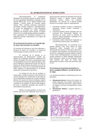 16. APARATO GENITAL MASCULINO
           Macroscópicamente,      el    componente          paciente presente síntomas de dificultad miccional por
hiperplásico de la próstata muestra un patrón nodular        obstrucción uretral, y algunos tumores pueden
de acinos glandulares hiperplásicos separados por un         permanecer silentes, incluso con metástasis
estroma fibroso (fig. 16.12). Algunos nódulos están          diseminadas. Los cánceres de la próstata pueden
dilatados y forman quistes de contenido líquido              dividirse en tres grupos, según su comportamiento:
lechoso. Otros contienen numerosas concreciones
calcificadas (cuerpos amiláceos). Histológicamente,          1.   Carcinomas prostáticos invasivos. Clínicamente
los acinos son hiperplásicos y están densamente                   importantes porque invaden localmente y
agrupados y revestidos por células epiteliales                    metastatizan.
cilíndricas con pequeños núcleos basales; el epitelio        2.   Carcinoma prostático latente. Pequeños focos de
forma de vez en cuando pliegues papilares irregulares.            carcinoma bien diferenciado, hallados con
Otro componente del crecimiento prostático es la                  frecuencia de forma casual en próstatas de
hipertrofia muscular, especialmente en la región del              ancianos. Parecen permanecer confinados en la
cuello vesical.                                                   próstata durante largo tiempo.
                                                             3.   Carcinomas ocultos clínicamente inaparentes en
                                                                  su localización primaria, pero con metástasis.
El carcinoma de la próstata es el segundo tipo
de cáncer más frecuente en el hombre                                   Macroscópicamente, los carcinomas de la
                                                             próstata aparecen como zonas difusas de tejido
El carcinoma de la próstata es una causa importante y        blanquecino firme, fusionado con el tejido
frecuente de cáncer en el hombre y su frecuencia             fibromuscular del estroma. Es frecuente la distorsión y
aumenta progresivamente a partir de los 55 años.             la extensión extra prostática, con formación de una
                                                             masa firme y granujienta que puede palparse mediante
          El carcinoma de la próstata es un                  el tacto rectal. Histológicamente, la mayoría de las
adenocarcinoma de diferenciación variable, que               lesiones presentan un patrón glandular diferenciado
aparece en las glándulas prostáticas verdaderas de la        (buen pronóstico), aunque en una proporción menor
periferia del órgano. Por tanto, su diseminación local       están formados por capas de células poco
es más probable a través de la cápsula prostática, antes     diferenciadas sin patrón acinar (mal pronóstico) (fig.
que la infiltración central hacia la uretra. Por ello, los   16.13).
intentos de obtener biopsias de próstata con el fin de
diagnosticar el cáncer por vía transuretral pueden dar
falsos negativos; la punción-biopsia de la próstata          El carcinoma de la próstata metastatiza en
externa por vía transrectal es más eficaz.                   hueso y ganglios linfáticos e invade la base de
                                                             la vejiga
          La etiología de este tipo de neoplasia es
desconocida y, aunque los tumores suelen estar bajo el       Los carcinomas prostáticos se diseminan por tres vías
control endocrino de la testosterona, no hay datos de        principales:
que el desequilibrio hormonal sea un factor etiológico
primario. En ausencia de factores etiológicos seguros        •    Diseminación directa a la base de la vejiga y los
no es posible una estrategia preventiva primaria para el          tejidos adyacentes. Esto produce obstrucción de
carcinoma de la próstata; el esfuerzo debe dirigirse,             la uretra (dificultad miccional) y puede obstruir
por tanto, a desarrollar estrategias para detectar la             los uréteres y provocar una hidronefrosis (véase
enfermedad en fases precoces.                                     pág. 344).
                                                             •    Diseminación linfática a ganglios pélvicos y
          Debido a su origen periférico, el cáncer de la          paraaórticos.
próstata suele estar bien establecido antes de que el




                                                                                                               359
 