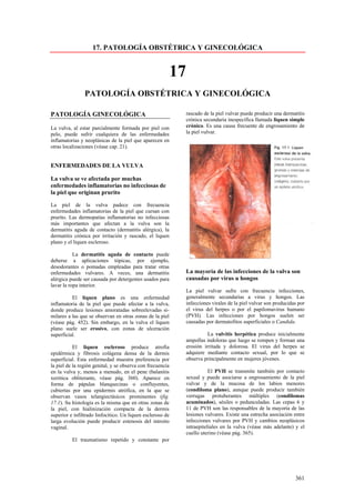 17. PATOLOGÍA OBSTÉTRICA Y GINECOLÓGICA


                                                            17
                PATOLOGÍA OBSTÉTRICA Y GINECOLÓGICA

PATOLOGÍA GINECOLÓGICA                                           rascado de la piel vulvar puede producir una dermatitis
                                                                 crónica secundaria inespecífica llamada liquen simple
La vulva, al estar parcialmente formada por piel con             crónico. Es una causa frecuente de engrosamiento de
pelo, puede sufrir cualquiera de las enfermedades                la piel vulvar.
inflamatorias y neoplásicas de la piel que aparecen en
otras localizaciones (véase cap. 21).


ENFERMEDADES DE LA VULVA

La vulva se ve afectada por muchas
enfermedades inflamatorias no infecciosas de
la piel que originan prurito

La piel de la vulva padece con frecuencia
enfermedades inflamatorias de la piel que cursan con
prurito. Las dermopatías inflamatorias no infecciosas
más importantes que afectan a la vulva son la
dermatitis aguda de contacto (dermatitis alérgica), la
dermatitis crónica por irritación y rascado, el liquen
plano y el liquen escleroso.

           La dermatitis aguda de contacto puede
deberse a aplicaciones tópicas, por ejemplo,
desodorantes o pomadas empleadas para tratar otras
enfermedades vulvares. A veces, una dermatitis                   La mayoría de las infecciones de la vulva son
alérgica puede ser causada por detergentes usados para           causadas por virus u hongos
lavar la ropa interior.
                                                                 La piel vulvar sufre con frecuencia infecciones,
          El liquen plano es una enfermedad                      generalmente secundarias a virus y hongos. Las
inflamatoria de la piel que puede afectar a la vulva,            infecciones virales de la piel vulvar son producidas por
donde produce lesiones amoratadas sobreelevadas si-              el virus del herpes o por el papilomavirus humano
milares a las que se observan en otras zonas de la piel          (PVH). Las infecciones por hongos suelen ser
(véase pág. 452). Sin embargo, en la vulva el liquen             causadas por dermatofitos superficiales o Candida.
plano suele ser erosivo, con zonas de ulceración
superficial.                                                               La vulvitis herpética produce inicialmente
                                                                 ampollas indoloras que luego se rompen y forman una
           El liquen escleroso produce atrofia                   erosión irritada y dolorosa. El virus del herpes se
epidérmica y fibrosis colágena densa de la dermis                adquiere mediante contacto sexual, por lo que se
superficial. Esta enfermedad muestra preferencia por             observa principalmente en mujeres jóvenes.
la piel de la región genital, y se observa con frecuencia
en la vulva y, menos a menudo, en el pene (balanitis                        El PVH se transmite también por contacto
xerótica obliterante, véase pág. 360). Aparece en                sexual y puede asociarse a engrosamiento de la piel
forma de pápulas blanquecinas o confluyentes,                    vulvar y de la mucosa de los labios menores
cubiertas por una epidermis atrófica, en la que se               (condiloma plano), aunque puede producir también
observan vasos telangiectásicos prominentes (fig.                verrugas protuberantes múltiples (condilomas
17.1). Su histología es la misma que en otras zonas de           acuminados), sésiles o pedunculadas. Las cepas 6 y
la piel, con hialinización compacta de la dermis                 11 de PVH son las responsables de la mayoría de las
superior e infiltrado linfocítico. Un liquen escleroso de        lesiones vulvares. Existe una estrecha asociación entre
larga evolución puede producir estenosis del introito            infecciones vulvares por PVH y cambios neoplásicos
vaginal.                                                         intraepiteliales en la vulva (véase más adelante) y el
                                                                 cuello uterino (véase pág. 365).
          El traumatismo repetido y constante por




                                                                                                                    361
 