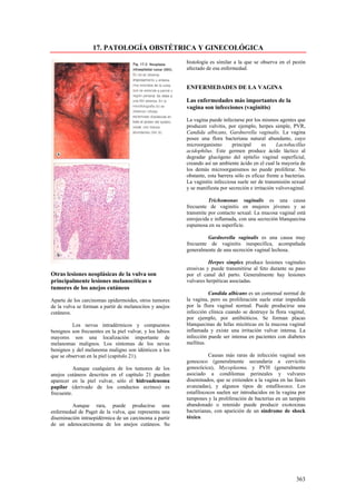17. PATOLOGÍA OBSTÉTRICA Y GINECOLÓGICA
                                                          histología es similar a la que se observa en el pezón
                                                          afectado de esa enfermedad.


                                                          ENFERMEDADES DE LA VAGINA

                                                          Las enfermedades más importantes de la
                                                          vagina son infecciones (vaginitis)

                                                          La vagina puede infectarse por los mismos agentes que
                                                          producen vulvitis, por ejemplo, herpes simple, PVR,
                                                          Candida albicans, Gardnerella vaginalis. La vagina
                                                          posee una flora bacteriana natural abundante, cuyo
                                                          microorganismo        principal     es     Lactobacillus
                                                          acidophilus. Este germen produce ácido láctico al
                                                          degradar glucógeno del epitelio vaginal superficial,
                                                          creando así un ambiente ácido en el cual la mayoría de
                                                          los demás microorganismos no puede proliferar. No
                                                          obstante, esta barrera sólo es eficaz frente a bacterias.
                                                          La vaginitis infecciosa suele ser de transmisión sexual
                                                          y se manifiesta por secreción e irritación vulvovaginal.

                                                                    Trichomonas vaginalis es una causa
                                                          frecuente de vaginitis en mujeres jóvenes y se
                                                          transmite por contacto sexual. La mucosa vaginal está
                                                          enrojecida e inflamada, con una secreción blanquecina
                                                          espumosa en su superficie.

                                                                   Gardnerella vaginalis es una causa muy
                                                          frecuente de vaginitis inespecífica, acompañada
                                                          generalmente de una secreción vaginal lechosa.

                                                                    Herpes simplex produce lesiones vaginales
                                                          erosivas y puede transmitirse al feto durante su paso
Otras lesiones neoplásicas de la vulva son                por el canal del parto. Generalmente hay lesiones
principalmente lesiones melanocíticas o                   vulvares herpéticas asociadas.
tumores de los anejos cutáneos
                                                                    Candida albicans es un comensal normal de
Aparte de los carcinomas epidermoides, otros tumores      la vagina, pero su proliferación suele estar impedida
de la vulva se forman a partir de melanocitos y anejos    por la flora vaginal normal. Puede producirse una
cutáneos.                                                 infección clínica cuando se destruye la flora vaginal,
                                                          por ejemplo, por antibióticos. Se forman placas
          Los nevus intradérmicos y compuestos            blanquecinas de hifas micóticas en la mucosa vaginal
benignos son frecuentes en la piel vulvar, y los labios   inflamada y existe una irritación vulvar intensa. La
mayores son una localización importante de                infección puede ser intensa en pacientes con diabetes
melanomas malignos. Los síntomas de los nevus             mellitus.
benignos y del melanoma maligno son idénticos a los
que se observan en la piel (capitulo 21).                           Causas más raras de infección vaginal son
                                                          gonococo (generalmente secundaria a cervicitis
           Aunque cualquiera de los tumores de los        gonocócica), Mycoplasma, y PVH (generalmente
anejos cutáneos descritos en el capítulo 21 pueden        asociado a condilomas perineales y vulvares
aparecer en la piel vulvar, sólo el hidroadenoma          diseminados, que se extienden a la vagina en las fases
papilar (derivado de los conductos ecrinos) es            avanzadas), y algunos tipos de estafilococo. Los
frecuente.                                                estafilococos suelen ser introducidos en la vagina por
                                                          tampones y la proliferación de bacterias en un tampón
         Aunque rara, puede producirse una                abandonado o retenido puede producir exotoxinas
enfermedad de Paget de la vulva, que representa una       bacterianas, con aparición de un síndrome de shock
diseminación intraepidérmica de un carcinoma a partir     tóxico.
de un adenocarcinoma de los anejos cutáneos. Su




                                                                                                              363
 