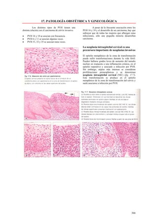 17. PATOLOGÍA OBSTÉTRICA Y GINECOLÓGICA
           Los distintos tipos de PVH tienen una                   A pesar de la frecuente asociación entre los
distinta relación con el carcinoma de cérvix invasivo.   PVH 16 y 18 y el desarrollo de un carcinoma, hay que
                                                         subrayar que de todas las mujeres que albergan estas
•   PVH 16 y 18 se asocian con frecuencia.               infecciones, sólo una pequeña minoría desarrollan
•   PVH 6 y 11 se asocian algunas veces.                 carcinoma.
•   PVH 31, 33 y 35 se asocian raras veces.

                                                         La neoplasia intraepitelial cervical es una
                                                         precursora importante de neoplasias invasivas

                                                         El epitelio metaplásico de la zona de transformación
                                                         puede sufrir transformaciones durante la vida fértil.
                                                         Pueden hallarse grados leves de aumento del tamaño
                                                         nuclear en respuesta a una inflamación crónica, en el
                                                         epitelio reparativo y asociado a infección por PVH.
                                                         Sin embargo, atipias más intensas se consideran
                                                         proliferaciones preneoplásicas y se denominan
                                                         neoplasia intraepitelial cervical (NIC) (fig. 17.7).
                                                         Esta transformación se produce en el epitelio
                                                         metaplásico de la zona de transformación del cérvix y
                                                         suele asociarse a infección por PVH.




                                                                                                          366
 