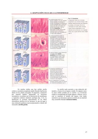 2. ADAPTACIÓN CELULAR A LA ENFERMEDAD




           En muchos tejidos que han sufrido atrofia                  La atrofia suele asociaría a una reducción del
celular se acumula un pigmento pardo llamado lipofuscina   tamaño y el peso de un órgano o tejido. En algunos casos
dentro de las células encogidas. El pigmento, compuesto    la masa celular perdida por la atrofia o la involución
por material lipídico degenerado en lisosomas              celular es reemplazada por tejido adiposo o fibroso, con lo
secundarios, se produce por la destrucción de membranas    cual se mantiene el tamaño del órgano. Este tejido
y orgánulos celulares mediante autofagia (fig. 2.13). La   sustitutivo con frecuencia aparece en forma de un material
lipofuscina se acumula especialmente en las fibras         muy eosinófilo llamado sustancia hialina.
miocárdicas atróficas de los ancianos, lo que da lugar a
una coloración parduzca macroscópicamente evidente del
miocardio (atrofia parda).




                                                                                                                   17
 