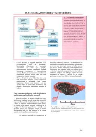 17. PATOLOGÍA OBSTÉTRICA Y GINECOLÓGICA




•   Causas durante el segundo trimestre. Son              mucosa y submucosa tubáricas, y la proliferación del
    corioamnionitis,      rotura     de     membranas,    trofoblasto erosiona los vasos sanguíneos submucosos,
    hemorragias       placentarias      y    anomalías    y provoca una hemorragia intensa en la luz tubárica
    estructurales     del     útero    (por   ejemplo,    (fig. 17.26). Muchos embarazos ectópicos tubáricos se
    malformaciones uterinas congénitas), grandes          manifiestan por abdomen agudo, con intenso dolor
    leiomiomas submucosos e incompetencia                 abdominal bajo, localizado generalmente en el lado del
    cervical. Pueden producirse abortos secundarios a     embarazo ectópico; sin embargo, algunos de estos
    placentación anormal, aunque éstos son más            embarazos se rompen y sangran en la cavidad
    frecuentes en el tercer trimestre.                    peritoneal, en cuyo caso el dolor es menos localizado.
•   Causas durante el tercer trimestre. Son sobre
    todo alteraciones maternas, como hipertensión
    descontrolada o eclampsia. Otras causas
    importantes durante este trimestre son los
    diversos tipos de alteraciones placentarias, por
    ejemplo, hemorragias placentarias, abruptio e
    infarto.


En el embarazo ectópico el óvulo fertilizado se
implanta en una localización anormal

La gestación ectópica se produce cuando un óvulo
fertilizado se implanta fuera de la cavidad uterina. El
lugar más frecuente de implantación es la trompa de
Falopio. El embarazo ectópico tubárico es más proba-
ble cuando existe alguna anomalía estructural de la
trompa de Falopio, generalmente causada por
episodios previos de salpingitis, aunque un factor
predisponente cada vez más frecuente es la cirugía
tubárica previa con fines anticonceptivos.

         El embrión fertilizado se implanta en la




                                                                                                           383
 