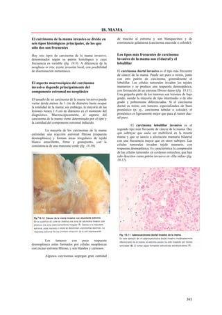 18. MAMA

El carcinoma de la mama invasivo se divide en               de mucina al estroma y son blanquecinos y de
seis tipos histológicos principales, de los que             consistencia gelatinosa (carcinoma mucoide o coloide).
sólo dos son frecuentes

Hay seis tipos de carcinoma de la mama invasivo,            Los tipos más frecuentes de carcinoma
denominados según su patrón histológico y cuya              invasivo de la mama son el ductal y el
frecuencia es variable (fig. 18.9). A diferencia de la      lobulillar
neoplasia in situ, existe invasión local, con posibilidad
de diseminación metastásica.                                El carcinoma ductal invasivo es el tipo más frecuente
                                                            de cáncer de la mama. Puede ser puro o mixto, junto
                                                            con otro patrón de carcinoma, generalmente el
El aspecto macroscópico del carcinoma                       lobulillar. Las células tumorales invaden los tejidos
invasivo depende principalmente del                         mamarios y se produce una respuesta desmoplásica,
componente estromal no neoplásico                           con formación de un estroma fibroso denso (fig. 18.11).
                                                            Una pequeña parte de los tumores son lesiones de bajo
El tamaño de un carcinoma de la mama invasivo puede         grado, siendo la mayoría de tipo intermedio o de alto
variar desde menos de 1 cm de diámetro hasta ocupar         grado y pobremente diferenciadas. Si el carcinoma
la totalidad de la mama; sin embargo, la mayoría de las     ductal es mixto con tumores especializados de buen
lesiones tienen 1-3 cm de diámetro en el momento del        pronóstico (p. ej., carcinoma tubular o coloide), el
diagnóstico. Macroscópicamente, el aspecto del              pronóstico es ligeramente mejor que para el tumor duc-
carcinoma de la mama viene determinado por el tipo y        tal puro.
la cantidad del componente estromal inducido.
                                                                      El carcinoma lobulillar invasivo es el
          La mayoría de los carcinomas de la mama           segundo tipo más frecuente de cáncer de la mama. Hay
estimulan una reacción estromal fibrosa (respuesta          que subrayar que suele ser multifocal en la misma
desmoplásica) y forman áreas irregulares de tejido          mama y que se asocia a afectación mamaria bilateral
blanco amarillento, firme y granujiento, con la             con una frecuencia mayor que en otros subtipos. Las
consistencia de una manzana verde (fig. 18.10).             células tumorales invaden tejido mamario, con
                                                            respuesta desmoplásica. Es característica la compresión
                                                            de las células tumorales en cordones estrechos, que han
                                                            sido descritos como patrón invasivo en «fila india» (fig.
                                                            18.12).




         Los     tumores      con    poca     respuesta
desmoplásica están formados por células neoplásicas
con escaso estroma fibroso, y son blandos y carnosos.

          Algunos carcinomas segregan gran cantidad




                                                                                                                393
 