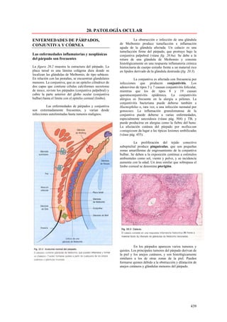 20. PATOLOGÍA OCULAR

ENFERMEDADES DE PÁRPADOS,                                             La obstrucción e infección de una glándula
CONJUNTIVA Y CÓRNEA                                        de Meibomio produce tumefacción e inflamación
                                                           aguda de la glándula afectada. Un calacio es una
                                                           tumefacción firme del párpado, que protruye bajo la
Las enfermedades inflamatorias y neoplásicas               conjuntiva palpebral (véase fig. 20.6a). Se debe a la
del párpado son frecuentes                                 rotura de una glándula de Meibomio y consiste
                                                           histológicamente en una respuesta inflamatoria crónica
La figura 20.2 muestra la estructura del párpado. La       histiocitaria de cuerpo extraño frente a un material rico
placa tarsal es una lámina colágena dura donde se          en lípidos derivado de la glándula destruida (fig. 20.3).
localizan las glándulas de Meibomio, de tipo sebáceo.
En relación con las pestañas, se encuentran glandulares              La conjuntiva es afectada con frecuencia por
menores. La conjuntiva, que es un epitelio cilíndrico de   infecciones que producen conjuntivitis. Los
dos capas que contiene células calciformes secretoras      adenovirus de tipos 3 y 7 causan conjuntivitis folicular,
de moco, reviste los párpados (conjuntiva palpebral) y     mientras que los de tipos 8 y 19 causan
cubre la parte anterior del globo ocular (conjuntiva       queratoconjuntivitis epidémica. La conjuntivitis
bulbar) hasta el límite con el epitelio corneal (limbo).   alérgica es frecuente en la alergia a pólenes. La
                                                           conjuntivitis bacteriana puede deberse también a
          Las enfermedades de párpados y conjuntiva        Haemophilus o, rara vez, a una infección neonatal por
son extremadamente frecuentes, y varían desde              gonococo. La inflamación granulomatosa de la
infecciones autolimitadas hasta tumores malignos.          conjuntiva puede deberse a varias enfermedades,
                                                           especialmente sarcoidosis (véase pág. 504) y TB, y
                                                           puede producirse en alergias como la fiebre del heno.
                                                           La afectación cutánea del párpado por molluscum
                                                           contagiosum da lugar a las típicas lesiones umbilicadas
                                                           (véase pág. 455).

                                                                     La proliferación del tejido conectivo
                                                           subepitelial produce pinguéculas, que son pequeñas
                                                           zonas amarillentas de engrosamiento de la conjuntiva
                                                           bulbar. Se deben a la exposición continua a estímulos
                                                           ambientales como sol, viento y polvo, y su incidencia
                                                           aumenta con la edad. Un área similar que sobrepasa el
                                                           limbo corneal se denomina pterigión.




                                                                     En los párpados aparecen varios tumores y
                                                           quistes. Los principales tumores del párpado derivan de
                                                           la piel y los anejos cutáneos, y son histológicamente
                                                           similares a los de otras zonas de la piel. Pueden
                                                           formarse quistes debido a la obstrucción y dilatación de
                                                           anejos cutáneos y glándulas menores del párpado.




                                                                                                               439
 
