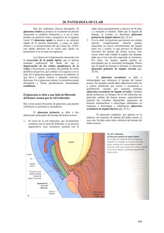 20. PATOLOGÍA OCULAR
          Hay dos síndromes clínicos principales. El             edad; afecta principalmente a mayores de 40 años
glaucoma crónico se produce si el aumento de presión             y a menudo es familiar. Dado que el ángulo de
intraocular se establece lentamente y, si no se trata,           drenaje es normal, se denomina glaucoma
produce un deterioro lento y progresivo de la agudeza            primario de ángulo abierto (fig. 20.5a).
visual. El glaucoma agudo se asocia a un aumento            2.   Con la edad, los pacientes que poseen una cámara
rápido de la presión intraocular, y causa un dolor               anterior    congénitamente     estrecha   pueden
intenso y el enrojecimiento del ojo (véase fig. 20.6b),          desarrollar un mayor estrechamiento del ángulo
con rápido deterioro de la visión (que puede ser                 entre iris y córnea, lo que provoca un bloqueo
permanente si no se trata con urgencia).                         funcional del drenaje del humor acuoso. Esto
                                                                 ocurre sobre todo cuando la pupila está dilatada,
           Los efectos de la hipertensión intraocular son        dado que el iris está más engrosado al contraerse.
la excavación de la papila óptica, que se detecta                Por tanto, los ataques agudos pueden ser
mediante exploración del fondo del ojo, y                        precipitados por la oscuridad prolongada. Puesto
degeneración de las células ganglionares de la                   que el ángulo de drenaje es anormal, se denomina
retina. Clínicamente se produce una pérdida de visión            glaucoma primario de ángulo cerrado (fig.
periférica progresiva, que conduce a la ceguera si no se         20.5b).
trata. En el glaucoma agudo se destruye el endotelio, lo
que lleva a edema corneal y ampollas corneales                        El glaucoma secundario se debe a
dolorosas. En el glaucoma crónico, la esclerótica puede     enfermedades que obstruyen el drenaje del humor
distenderse y forma protuberancias denominadas              acuoso. Por ejemplo, puede haber adherencias entre iris
estafilomas.                                                y córnea producidas por uveítis o secundarias a
                                                            proliferación vascular por isquemia retiniana
                                                            (glaucoma secundario de ángulo cerrado). También
El glaucoma se debe a una falta de filtración               puede producirse un bloqueo de la red trabecular por
del humor acuoso por la red trabecular                      partículas sólidas del humor acuoso, especialmente
                                                            material del cristalino degenerado, pigmentos de
Hay varias causas frecuentes de glaucoma, que pueden        lesiones melanocíticas o macrófagos abundantes en
clasificarse en primarias y secundarias.                    respuesta a hemorragia o inflamación (glaucoma
                                                            secundario de ángulo abierto) (fig. 20.5c).
          El glaucoma primario se debe a dos
alteraciones principales del drenaje del humor acuoso:                El glaucoma congénito, que aparece en la
                                                            infancia, con aumento de tamaño del globo ocular, es
1.   El cierre de la red trabecular, que normalmente        muy raro. Se debe sobre todo a defectos del drenaje del
     comunica con el canal de Schlemm, es un proceso        humor acuoso.
     degenerativo cuya incidencia aumenta con la




                                                                                                              444
 