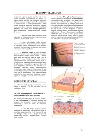 21. DERMATOPATOLOGÍA
la epidermis y pueden quedar atrapadas bajo la capa                     El virus del papiloma humano produce
córnea engrosada (microabscesos de Monro). En                lesiones epidérmicas proliferativas (verrugas víricas),
algunos tipos de psoriasis, gran cantidad de neutrófilos     cuya naturaleza varía de un lugar a otro, desde lesiones
polimorfonucleares emigran a través de la epidermis y        arborescentes exofíticas filiformes (fig. 21.7a) o
se acumulan bajo la costra paraqueratótica, donde            pequeñas placas planas (p. ej., verrugas planas en la
forman grupos de neutrófilos reconocibles a simple           cara) hasta lesiones hiperqueratóticas profundamente
vista como focos purulentos de color amarillento             invertidas (p. ej., verrugas plantares de la planta del
(pústulas). Se conoce como psoriasis pustular y              pie) (fig. 21.7c). En la piel del periné, el virus del
afecta habitualmente a palmas de las manos y plantas         papiloma humano produce protuberancias exofíticas
de los pies.                                                 papilomatosas floridas denominadas condilomas
                                                             acuminados (fig. 21.7b); el virus puede infectar
          La psoriasis puede afectar también al lecho        también la mucosa genital y anal, tanto en varones
ungueal, y ser causa de depresiones, engrosamiento y,        como en mujeres, y se considera un factor etiológico
finalmente, destrucción de la uña.                           para el desarrollo de carcinomas en esa región.

          En otras enfermedades pueden aparecer
alteraciones cutáneas de tipo inflamatorio con algunos
de los rasgos clínicos e histológicos de la psoriasis
(dermatitis psoriasiforme), por ejemplo, las lesiones
cutáneas del síndrome de Reiter.

            La pitiriasis rosada es una dermopatía
frecuente en jóvenes. Una lesión típica consiste en una
placa eritematosa rodeada por una escama. La primera
lesión suele ser una gran placa de hasta 2 cm de
diámetro («placa heraldo»), pero las lesiones
subsiguientes suelen ser de menor tamaño; todas se
caracterizan por una escama que comienza en el centro
de la lesión y se extiende hacia la periferia al crecer la
lesión. La pitiriasis rosada es la más frecuente de las
dermatitis      conocidas      como    «pitiriasiformes»,
caracterizadas todas ellas por la presencia de una
escama blanquecina que histológicamente corresponde
a una zona de paraqueratosis. Otros tipos de erupción
pitiriasiforme, como la pitiriasis liquenoide crónica y
la pitiriasis rubra pilar, son mucho menos frecuentes.


INFECCIONES CUTÁNEAS

Las infecciones de la piel pueden deberse a virus,
hongos o bacterias. Las más frecuentes son las
causadas por virus.


Los virus pueden producir efectos directos e
indirectos en las infecciones cutáneas

Son tres los principales grupos de virus que afectan a
la piel directamente, y producen lesiones con
presencia de partículas víricas (generalmente
numerosas), a veces en forma de inclusiones
intracelulares.

          Los virus del herpes producen lesiones
ampollosas en la epidermis, con inclusiones víricas en
las células epidérmicas (fig. 21.6). Ejemplos de ello
son el herpes simple de tipo I (herpes no genital),
herpes simple de tipo 2 (herpes genital) y herpes
zóster-varicela.




                                                                                                                453
 