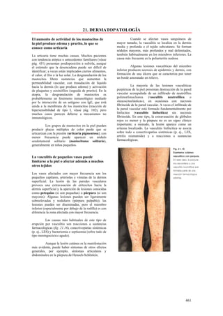 21. DERMATOPATOLOGÍA

El aumento de actividad de los mastocitos de                          Cuando se afectan vasos sanguíneos de
la piel produce edema y prurito, lo que se                   mayor tamaño, la vasculitis se localiza en la dermis
conoce como urticaria                                        media y profunda o el tejido subcutáneo. Se forman
                                                             nódulos mayores, más profundos y mal delimitados,
La urticaria tiene muchas causas. Muchos pacientes           también habitualmente en los miembros inferiores. La
con tendencia atópica o antecedentes familiares (véase       causa más frecuente es la poliarteritis nodosa.
pág. 451) presentan predisposición a sufrirla, aunque
el estimulo que la desencadena puede ser difícil de                     Algunas lesiones vasculíticas del miembro
identificar; a veces están implicados ciertos alimentos,     inferior producen necrosis de epidermis y dermis, con
el calor, el frío o la luz solar. La desgranulación de los   formación de una úlcera que se caracteriza por tener
mastocitos libera sustancias que aumentan la                 un borde amoratado en relieve.
permeabilidad vascular, con trasudación de líquido
hacia la dermis (lo que produce edema) y activación                    La mayoría de las lesiones vasculíticas
de plaquetas y eosinófilos (seguida de prurito). En la       purpúricas de la piel presentan destrucción de la pared
atopia, la desgranulación de mastocitos es                   vascular acompañada de un infiltrado de neutrófilos
probablemente un fenómeno inmunológico mediado               polimorfonucleares      (vasculitis   neutrofílica      o
por la interacción de un antígeno con IgE, que está          «leucocitoclástica»), en ocasiones con necrosis
unida a la membrana de los mastocitos (reacción de           fibrinoide de la pared vascular. A veces el infiltrado de
hipersensibilidad de tipo I, véase pág. 102), pero           la pared vascular está formado fundamentalmente por
muchos casos parecen deberse a mecanismos no                 linfocitos (vasculitis linfocítica) sin necrosis
inmunológicos.                                               fibrinoide. En este tipo, la extravasación de glóbulos
                                                             rojos es menor y la púrpura no es un signo clínico
          Los grupos de mastocitos en la piel pueden         importante; a menudo, la lesión aparece como un
producir placas múltiples de color pardo que se              eritema localizado. La vasculitis linfocítica se asocia
urticarizan con la presión (urticaria pigmentosa); con       sobre todo a conectivopatías sistémicas (p. ej., LES,
menor frecuencia puede aparecer un nódulo                    artritis reumatoide) y a reacciones a sustancias
seudotumoral solitario (mastocitoma solitario),              farmacológicas.
generalmente en niños pequeños.


La vasculitis de pequeños vasos puede
limitarse a la piel o afectar además a muchos
otros tejidos

Los vasos afectados con mayor frecuencia son los
pequeños capilares, arteriolas y vénulas de la dermis
superficial. La lesión de las paredes vasculares
provoca una extravasación de eritrocitos hacia la
dermis superficial y la aparición de lesiones conocidas
como petequias (si son pequeñas) o púrpura (si son
mayores). Algunas lesiones pueden ser ligeramente
sobreelevadas y nodulares (púrpura palpable); las
lesiones pueden ser diseminadas, pero el miembro
inferior (especialmente por debajo de la rodilla) es con
diferencia la zona afectada con mayor frecuencia.

           Las causas más habituales de este tipo de
erupción por vasculitis son reacciones a sustancias
farmacológicas (fig. 21.16), conectivopatías sistémicas
(p. ej., LES) y bacteriemia o septicemia (sobre todo de
tipo meningocócico agudo).

          Aunque la lesión cutánea es la manifestación
más evidente, puede haber síntomas de otros efectos
generales, por ejemplo, síntomas articulares y
abdominales en la púrpura de Henoch-Schönlein.




                                                                                                                 461
 