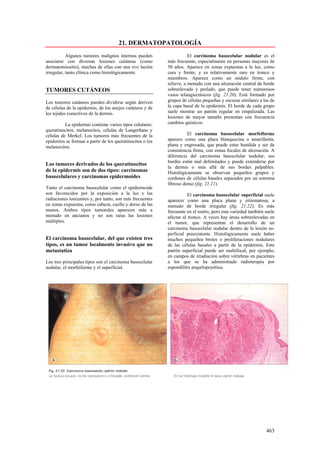 21. DERMATOPATOLOGÍA
           Algunos tumores malignos internos pueden                   El carcinoma basocelular nodular es el
asociarse con diversas lesiones cutáneas (como             más frecuente, especialmente en personas mayores de
dermatomiositis), muchas de ellas con una evo lución       50 años. Aparece en zonas expuestas a la luz, como
irregular, tanto clínica como histológicamente.            cara y frente, y es relativamente raro en tronco y
                                                           miembros. Aparece como un nódulo firme, con
                                                           relieve, a menudo con una ulceración central de borde
TUMORES CUTÁNEOS                                           sobreelevado y perlado, que puede tener numerosos
                                                           vasos telangiectásicos (fig. 21.20). Está formado por
Los tumores cutáneos pueden dividirse según deriven        grupos de células pequeñas y oscuras similares a las de
de células de la epidermis, de los anejos cutáneos y de    la capa basal de la epidermis. El borde de cada grupo
los tejidos conectivos de la dermis.                       suele mostrar un patrón regular en empalizada. Las
                                                           lesiones de mayor tamaño presentan con frecuencia
          La epidermis contiene varios tipos celulares:    cambios quísticos.
queratinocitos, melanocitos, células de Langerhans y
células de Merkel. Los tumores más frecuentes de la                  El carcinoma basocelular morfeiforme
epidermis se forman a partir de los queratinocitos o los   aparece como una placa blanquecina o amarillenta,
melanocitos.                                               plana y engrosada, que puede estar hundida y ser de
                                                           consistencia firme, con zonas focales de ulceración. A
                                                           diferencia del carcinoma basocelular nodular, sus
                                                           bordes están mal delimitados y puede extenderse por
Los tumores derivados de los queratinocitos
                                                           la dermis o más allá de sus bordes palpables.
de la epidermis son de dos tipos: carcinomas               Histológicamente se observan pequeños grupos y
basocelulares y carcinomas epidermoides                    cordones de células basales separados por un estroma
                                                           fibroso denso (fig. 21.21).
Tanto el carcinoma basocelular como el epidermoide
son favorecidos por la exposición a la luz y las                      El carcinoma basocelular superficial suele
radiaciones ionizantes y, por tanto, son más frecuentes    aparecer como una placa plana y eritematosa, a
en zonas expuestas, como cabeza, cuello y dorso de las     menudo de borde irregular (fig. 21.22). Es más
manos. Ambos tipos tumorales aparecen más a                frecuente en el rostro, pero esta variedad también suele
menudo en ancianos y no son raras las lesiones             afectar al tronco. A veces hay áreas sobreelevadas en
múltiples.                                                 el tumor, que representan el desarrollo de un
                                                           carcinoma basocelular nodular dentro de la lesión su-
                                                           perficial preexistente. Histológicamente suele haber
El carcinoma basocelular, del que existen tres             muchos pequeños brotes o proliferaciones nodulares
tipos, es un tumor localmente invasivo que no              de las células basales a partir de la epidermis. Este
metastatiza                                                patrón superficial puede ser multifocal, por ejemplo,
                                                           en campos de irradiación sobre vértebras en pacientes
Los tres principales tipos son el carcinoma basocelular    a los que se ha administrado radioterapia por
nodular, el morfeiforme y el superficial.                  espondilitis anquilopoyética.




                                                                                                              463
 