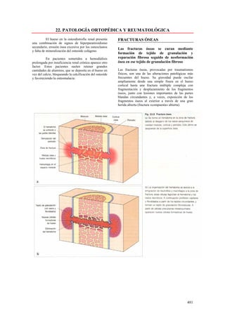 22. PATOLOGÍA ORTOPÉDICA Y REUMATOLÓGICA
           El hueso en la osteodistrofia renal presenta    FRACTURAS ÓSEAS
una combinación de signos de hiperparatiroidismo
secundario, erosión ósea excesiva por los osteoclastos
                                                           Las fracturas óseas se curan mediante
y falta de mineralización del osteoide colágeno.
                                                           formación de tejido de granulación y
          En pacientes sometidos a hemodiálisis            reparación fibrosa seguido de neoformación
prolongada por insuficiencia renal crónica aparece otro    ósea en ese tejido de granulación fibroso
factor. Estos pacientes suelen retener grandes
cantidades de aluminio, que se deposita en el hueso en     Las fracturas óseas, provocadas por traumatismos
vez del calcio, bloqueando la calcificación del osteoide   físicos, son una de las alteraciones patológicas más
y favoreciendo la osteomalacia.                            frecuentes del hueso. Su gravedad puede oscilar
                                                           ampliamente desde una simple fisura en el hueso
                                                           cortical hasta una fractura múltiple compleja con
                                                           fragmentación y desplazamiento de los fragmentos
                                                           óseos, junto con lesiones importantes de las partes
                                                           blandas circundantes y, a veces, exposición de los
                                                           fragmentos óseos al exterior a través de una gran
                                                           herida abierta (fractura «compuesta» abierta).




                                                                                                           481
 