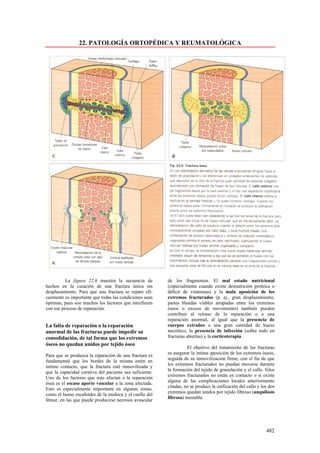 22. PATOLOGÍA ORTOPÉDICA Y REUMATOLÓGICA




          La figura 22.6 muestra la secuencia de         de los fragmentos. El mal estado nutricional
hechos en la curación de una fractura única sin          (especialmente cuando existe desnutrición proteica o
desplazamiento. Para que una fractura se repare efi-     déficit de vitaminas) y la mala aposición de los
cazmente es importante que todas las condiciones sean    extremos fracturados (p. ej., gran desplazamiento,
óptimas; pues son muchos los factores que interfieren    partes blandas viables atrapadas entre los extremos
con ese proceso de reparación.                           óseos o exceso de movimiento) también pueden
                                                         contribuir al retraso de la reparación o a una
                                                         reparación anormal, al igual que la presencia de
La falta de reparación o la reparación                   cuerpos extraños o una gran cantidad de hueso
anormal de las fracturas puede impedir su                necrótico, la presencia de infección (sobre todo en
consolidación, de tal forma que los extremos             fracturas abiertas) y la corticoterapia.
óseos no quedan unidos por tejido óseo
                                                                   El objetivo del tratamiento de las fracturas
                                                         es asegurar la íntima aposición de los extremos óseos,
Para que se produzca la reparación de una fractura es
                                                         seguida de su inmovilización firme, con el fin de que
fundamental que los bordes de la misma estén en
                                                         los extremos fracturados no puedan moverse durante
íntimo contacto, que la fractura esté inmovilizada y
                                                         la formación del tejido de granulación y el callo. Silos
que la capacidad curativa del paciente sea suficiente.
                                                         extremos fracturados no están en contacto o si existe
Uno de los factores que más afectan a la reparación
                                                         alguna de las complicaciones locales anteriormente
ósea es el escaso aporte vascular a la zona afectada.
                                                         citadas, no se produce la osificación del callo y los dos
Esto es especialmente importante en algunas zonas,
                                                         extremos quedan unidos por tejido fibroso (anquilosis
como el hueso escafoides de la muñeca y el cuello del
                                                         fibrosa) inestable.
fémur, en las que puede producirse necrosis avascular




                                                                                                             482
 