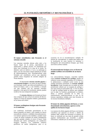 22. PATOLOGÍA ORTOPÉDICA Y REUMATOLÓGICA




El tumor osteoblástico más frecuente es el                ocasiones los de la encondromatosis múltiple. El
osteoma osteoide                                          término de «encondroma» se emplea para indicar que
                                                          la localización de estos tumores es intraósea, y
Los osteomas osteoides afectan sobre todo a los           distinguirlos del osteocondroma benigno, que forma
huesos largos de la pierna, especialmente en              una lesión exofitica nodular.
adolescentes y adultos jóvenes. Se manifiestan por
dolor óseo localizado en la zona de la lesión. Su
diámetro suele ser inferior a 2 cm y su radiología es     El osteocondroma benigno crece en forma de
típica, con una zona densa central rodeada por un halo    nódulo exofítico en la metáfisis de un hueso
de radiotransparencia ósea. Histológicamente están        largo
formados por osteoblastos activos, que depositan
grandes masas irregulares de osteoide colágeno de         Los osteocondromas benignos, conocidos también
forma aleatoria.                                          como exostosis recubiertas de cartílago, pueden ser
                                                          solitarios (como anomalía esporádica en la infancia y
           El denominado osteoma osteoide gigante u       la adolescencia) o múltiples (como ocurre en una
osteoclastoma benigno es un tumor de mayor tamaño,        entidad autosómica dominante, la exostosis múltiple
con histología similar, que afecta principalmente a los   hereditaria). Están formados por un nódulo de hueso
huesos de manos y pies, y a las vértebras; a menudo       protuberante cubierto por un casquete de cartílago y
son más celulares que los osteomas osteoides              una capa externa de pericondrio (fig. 22.10). En niños,
pequeños y más agresivos localmente; además, pueden       la capa de cartílago puede ser gruesa, pero adelgaza
recidivar tras una extirpación incompleta.                con la edad. Se localizan generalmente en húmero,
                                                          fémur y extremo proximal de la tibia. La
          El osteoma ebúrneo está formado por hueso       transformación condrosarcomatosa es rara en las
muy compacto de tipo cortical con sistemas de Havers.     lesiones esporádicas aisladas, pero más frecuente en
Aparece en forma de pequeños nódulos, generalmente        las lesiones hereditarias múltiples.
en los huesos del cráneo.

                                                          El tumor de células gigantes del hueso, a veces
El tumor cartilaginoso benigno más frecuente              denominado osteoclastoma, aparece en las
es el condroma                                            epífisis de los huesos largos
Los condromas, localizados generalmente en los            Los tumores de células gigantes del hueso son lesiones
huesos pequeños de manos y pies, pueden ser únicos        osteolíticas que aparecen en jóvenes y adultos de
(encondroma solitario) o múltiples (encondromatosis).     mediana edad, siendo más frecuentes en mujeres. El
Los tumores aparecen en las metáfisis y pueden surgir     hueso es sustituido por una masa de grandes células
a partir de nichos residuales de células cartilaginosas   gigantes multinucleares que recuerdan a grandes
que han quedado aislados al crecer el hueso. Están        osteoclastos, rodeadas por un estroma conectivo de
formados por matriz cartilaginosa con condrocitos
benignos dispersos. Los condromas solitarios
periféricos no suelen malignizarse, pero si en



                                                                                                            486
 
