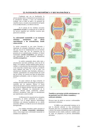 22. PATOLOGÍA ORTOPÉDICA Y REUMATOLÓGICA
           Cualquiera que sea su localización, la
artrosis produce dolor y limitación de movimientos en
la articulación afectada, a veces con tumefacción
evidente; esto se debe en parte a la presencia de
osteofitos óseos y en parte a la acumulación de líquido
en la cavidad articular y a la fibrosis sinovial.

           En la artrosis de las vértebras cervicales
(espondilosis cervical), la compresión de la salida de
los nervios raquídeos por osteofitos ocasiona gran
parte de los síntomas.


La enfermedad reumatoide es un trastorno
sistémico      autoinmune   que     afecta
especialmente a las articulaciones, donde
causa artritis

La artritis reumatoide es una causa frecuente e
importante de artropatía inflamatoria, aunque no es
más que una de las manifestaciones de un trastorno
sistémico (véase cap. 23). Se caracteriza por la
presencia de un autoanticuerpo circulante, el «factor
reumatoide» (artritis seropositiva), que distingue a
esta enfermedad de otras artropatías inflamatorias
(artritis seronegativas).

           La artritis reumatoide afecta sobre todo a
articulaciones sinoviales periféricas, como las de los
dedos y las muñecas, aunque también puede afectar a
rodillas y a articulaciones más proximales. Afecta dos
o tres veces más a mujeres que a varones, y la edad de
inicio habitual está entre 35 y los 45 años. Las
articulaciones afectadas están hinchadas, dolorosas y
calientes, generalmente con enrojecimiento de la piel
que las recubre. Se conocen tres tipos de alteraciones
patológicas principales, como se expone en la figura
22.13.

           En casos crónicos de larga evolución, el
cartílago articular puede estar destruido en gran parte y
sustituido por un «pannus» fibroso; el hueso
subyacente presenta erosiones osteolíticas y la sinovial
que reviste la cápsula articular está muy engrosada y
crónicamente inflamada. La disminución de la
superficie articular puede condicionar cambios
artrósicos secundarios, sobre todo en articulaciones
que soportan peso, como la rodilla.                         También se presentan artritis autoinmunes en
                                                            los pacientes con LES, fiebre reumática y
           A diferencia de la mayoría de las artropatías    esclerosis sistémica
autoinmunes, la artritis reumatoide es crónica y
progresiva. Con el tiempo aparecen deformidades             Diversos tipos de artritis se asocian a enfermedades
articulares, con síntomas secundarios (p. ej., atrofia      autoinmunes sistémicas.
muscular), debidos a la falta de uso de la articulación
desorganizada.                                                         El LES es una enfermedad sistémica en la
                                                            cual la afección articular es una manifestación
          Los cambios articulares suelen asociarse al       frecuente, pero leve. La artropatía suele ser transitoria
desarrollo de nódulos reumatoides subcutáneos;              y afecta a las mismas articulaciones que la enfermedad
éstos y otros rasgos de la enfermedad reumatoide se         reumatoide (es decir, dedos, muñecas y rodillas), pero
estudian en el capitulo 23.                                 no suele ser progresiva ni provoca deformidades
                                                            articulares.




                                                                                                                490
 