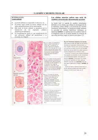 3. LESIÓN Y MUERTE CELULAR

PUNTOS CLAVE:                                                Las células muertas sufren una serie de
Lesión subletal                                              cambios estructurales denominada necrosis
•   La lesión subletal es recuperable; la necrosis, no.      La lesión letal va seguida de cambios estructurales
•   El primer signo visible de lesión subletal son los       definidos en las células, que reflejan la desintegración de
    daños ultraestructurales en las mitocondrias.            la estructura celular debida a la activación de enzimas
•   Más tarde la lesión subletal se manifiesta por la        lisosómicas intracelulares. La disolución celular mediante
    tumefacción      de     los   orgánulos      celulares   la actividad de enzimas hidrolíticas intrínsecas se
    (degeneración hidrópica).                                denomina autólisis. La autólisis provoca cambios tanto en
•   La transformación grasa es una manifestación de          el citoplasma como en el núcleo durante la evolución de
    una alteración subletal del metabolismo y es             una célula necrótica, según se muestra en la figura 3.8.
    frecuente en el hígado.




                                                                                                                    29
 