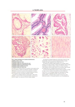 4. NEOPLASIA




               36
 