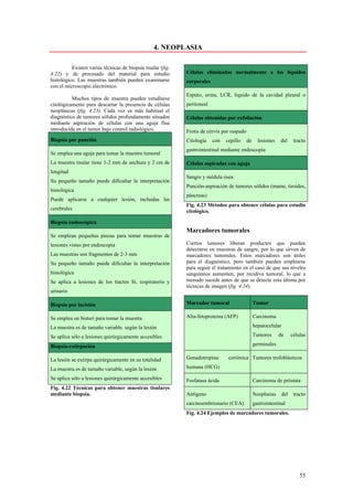 4. NEOPLASIA

          Existen varias técnicas de biopsia tisular (fig.
4.22) y de procesado del material para estudio               Células eliminadas normalmente a los líquidos
histológico. Las muestras también pueden examinarse          corporales
con el microscopio electrónico.
                                                             Esputo, orina, LCR, liquido de la cavidad pleural o
          Muchos tipos de muestra pueden estudiarse
citológicamente para descartar la presencia de células       peritoneal
neoplásicas (fig. 4.23). Cada vez es más habitual el
diagnóstico de tumores sólidos profundamente situados        Células obtenidas por exfoliación
mediante aspiración de células con una aguja fina
introducida en el tumor bajo control radiológico.            Frotis de cérvix por raspado
Biopsia por punción                                          Citología    con   cepillo     de     lesiones   del       tracto
                                                             gastrointestinal mediante endoscopia
Se emplea una aguja para tomar la muestra tumoral
La muestra tisular tiene 1-2 mm de anchura y 2 cm de         Células aspiradas con aguja
longitud
                                                             Sangre y médula ósea
Su pequeño tamaño puede dificultar la interpretación
                                                             Punción-aspiración de tumores sólidos (mame, tiroides,
histológica
                                                             páncreas)
Puede aplicarse a cualquier lesión, incluidas las
                                                             Fig. 4.23 Métodos para obtener células para estudio
cerebrales                                                   citológico.

Biopsia endoscópica
                                                             Marcadores tumorales
Se emplean pequeñas pinzas para tomar muestras de
lesiones vistas por endoscopia                               Ciertos tumores liberan productos que pueden
                                                             detectarse en muestras de sangre, por lo que sirven de
Las muestras son fragmentos de 2-3 mm                        marcadores tumorales. Estos marcadores son útiles
Su pequeño tamaño puede dificultar la interpretación         para el diagnóstico, pero también pueden emplearse
                                                             para seguir el tratamiento en el caso de que sus niveles
histológica                                                  sanguíneos aumenten, por recidiva tumoral, lo que a
Se aplica a lesiones de los tractos Sí, respiratorio y       menudo sucede antes de que se detecte esta última por
                                                             técnicas de imagen (fig. 4.24).
urinario

Biopsia por incisión                                         Marcador tumoral                    Tumor

Se emplea un bisturí para tomar la muestra                   Alta-fetoproteina (AFP)             Carcinoma

La muestra es de tamaño variable. según la lesión                                                hepatocelular

Se aplica sólo a lesiones quirúrgicamente accesibles                                             Tumores      de       células

Biopsia-extirpación                                                                              germinales

La lesión se extirpa quirúrgicamente en su totalidad         Gonadotropina       coriónica Tumores trofoblásticos

La muestra es de tamaño variable, según la lesión            humana (HCG)

Se aplica sólo a lesiones quirúrgicamente accesibles         Fosfatasa ácida                     Carcinoma de próstata
Fig. 4.22 Técnicas para obtener muestras tisulares
mediante biopsia.                                            Antígeno                            Neoplasias      del    tracto
                                                             carcinoembrionario (CEA)            gastrointestinal
                                                             Fig. 4.24 Ejemplos de marcadores tumorales.




                                                                                                                           55
 