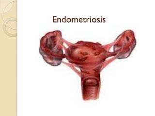 Endometriosis

 