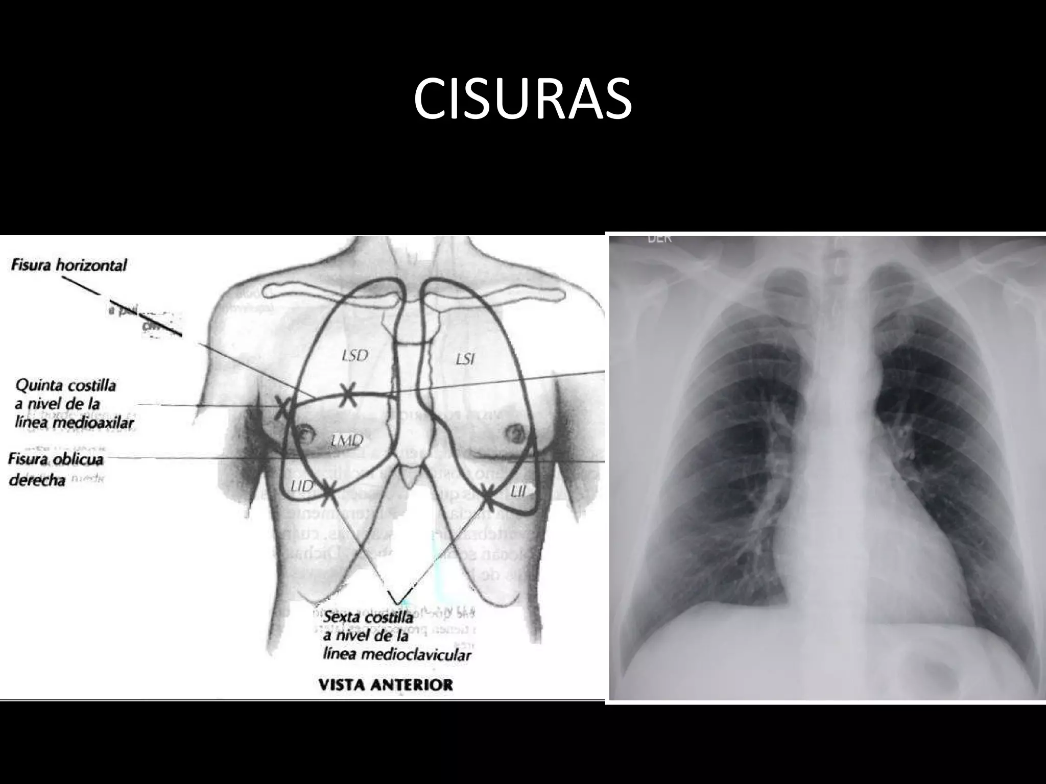 Torax Simple Anatomía radiológica de tórax | PPT