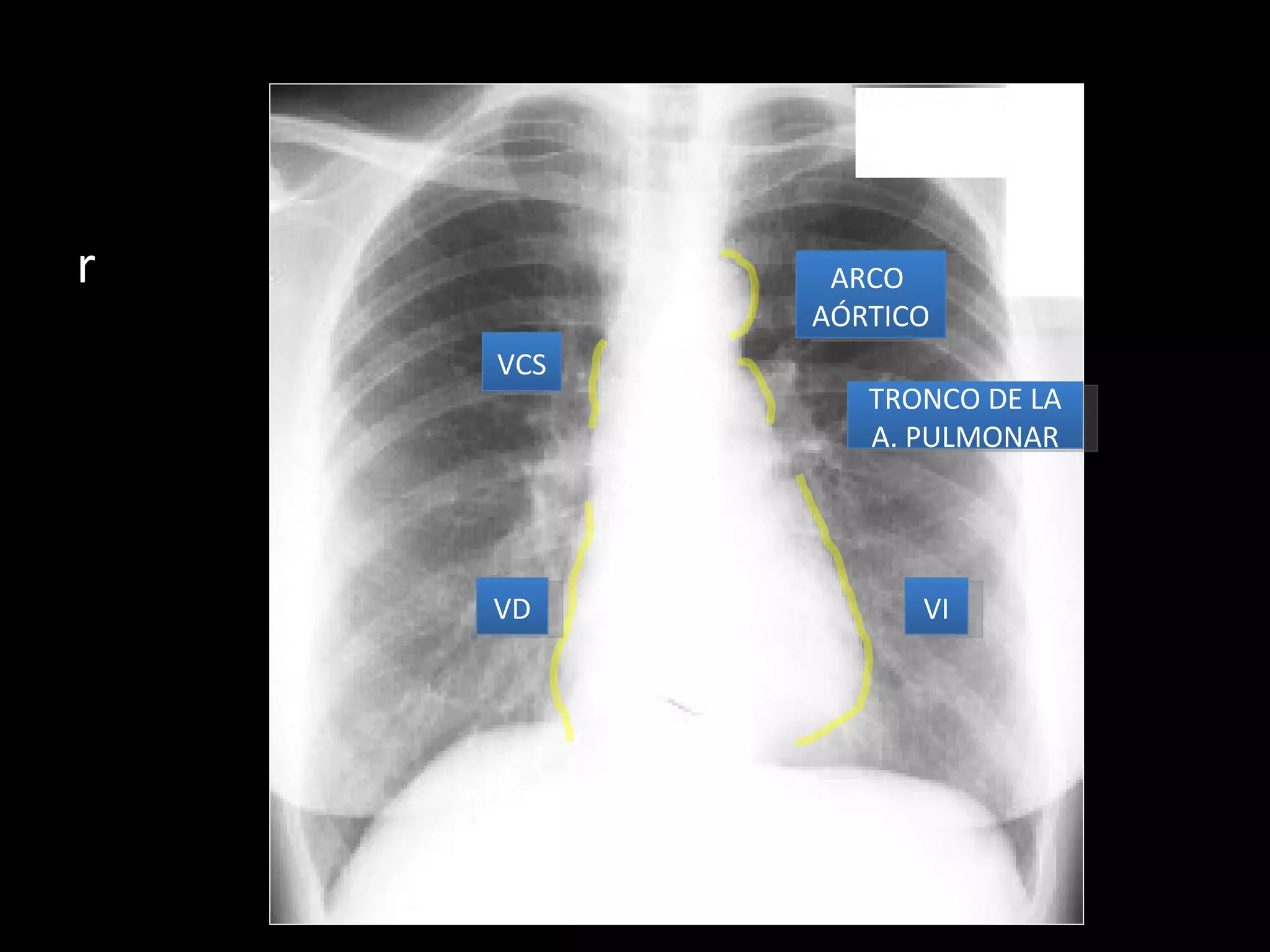 Torax Simple Anatomía radiológica de tórax | PPT