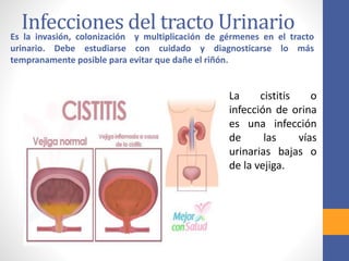Infecciones del tracto UrinarioEs la invasión, colonización y multiplicación de gérmenes en el tracto
urinario. Debe estudiarse con cuidado y diagnosticarse lo más
tempranamente posible para evitar que dañe el riñón.
La cistitis o
infección de orina
es una infección
de las vías
urinarias bajas o
de la vejiga.
 