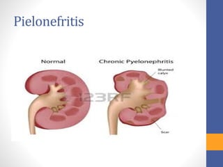 Pielonefritis
 