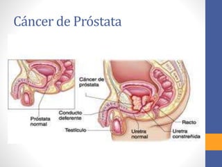 Cáncer de Próstata
 