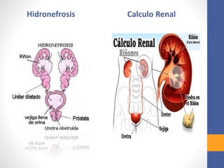 Hidronefrosis Calculo Renal
 