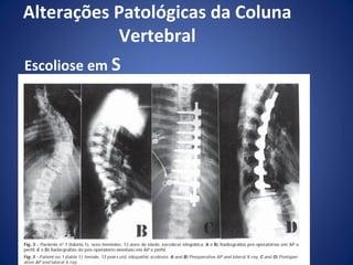 Alterações Patológicas da Coluna
Vertebral
Escoliose em S

 