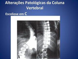Alterações Patológicas da Coluna
Vertebral
Escoliose em C

 