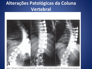 Alterações Patológicas da Coluna
Vertebral
Escoliose em C

 