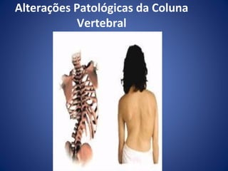 Alterações Patológicas da Coluna
Vertebral

 