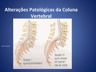 Alterações Patológicas da Coluna
Vertebral

Espondilolistese.

 