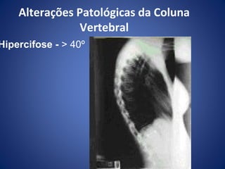 Alterações Patológicas da Coluna
Vertebral

Hipercifose - > 40º

 