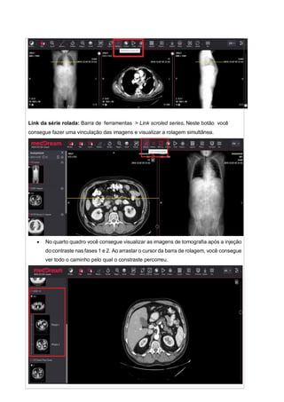 Link da série rolada: Barra de ferramentas > Link scroled series. Neste botão você
consegue fazer uma vinculação das imagens e visualizar a rolagem simultânea.
 No quarto quadro você consegue visualizar as imagens de tomografia após a injeção
do contraste nas fases 1 e 2. Ao arrastar o cursor da barra de rolagem, você consegue
ver todo o caminho pelo qual o constraste percorreu.
 