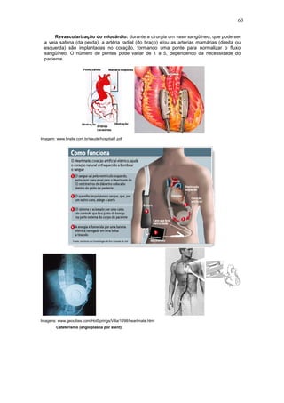 63
Revascularização do miocárdio: durante a cirurgia um vaso sangüíneo, que pode ser
a veia safena (da perda), a artéria radial (do braço) e/ou as artérias mamárias (direita ou
esquerda) são implantadas no coração, formando uma ponte para normalizar o fluxo
sangüíneo. O número de pontes pode variar de 1 a 5, dependendo da necessidade do
paciente.
Imagem: www.braile.com.br/saude/hospital1.pdf
Imagens: www.geocities.com/HotSprings/Villa/1298/heartmate.html
Cateterismo (angioplastia por stent):
 